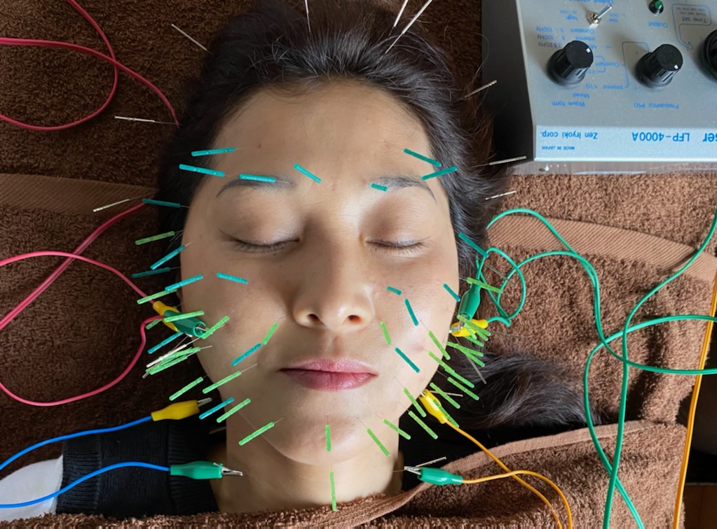 鍼灸院 侑秀 NIIGATA (リピーター限定)プレミアム美容鍼コースのメニュー画像