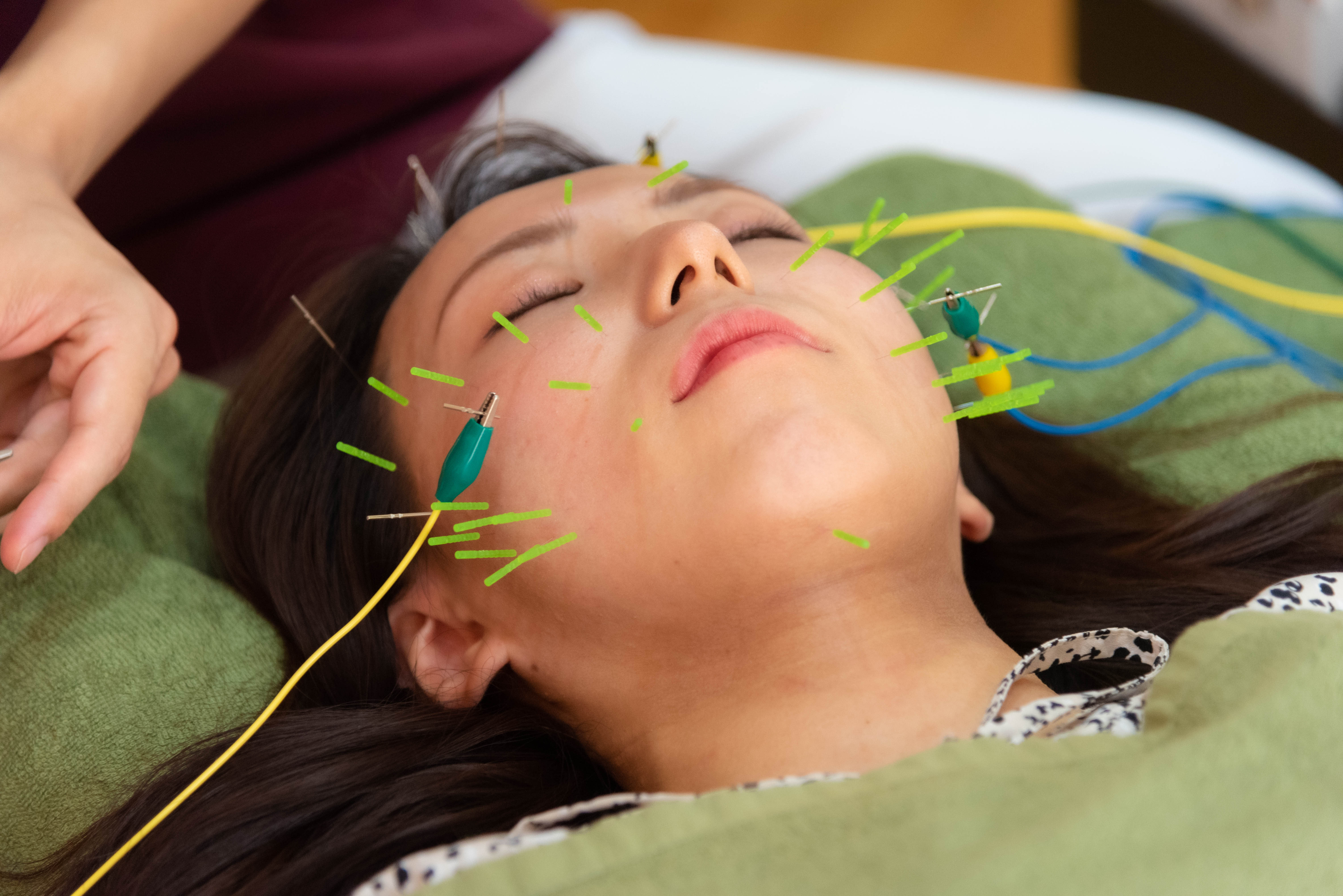 鍼灸マッサージ・美容鍼・ダイエット　藤井治療院 （初診）電気を流す優しい美容鍼（Bコース）のメニュー画像