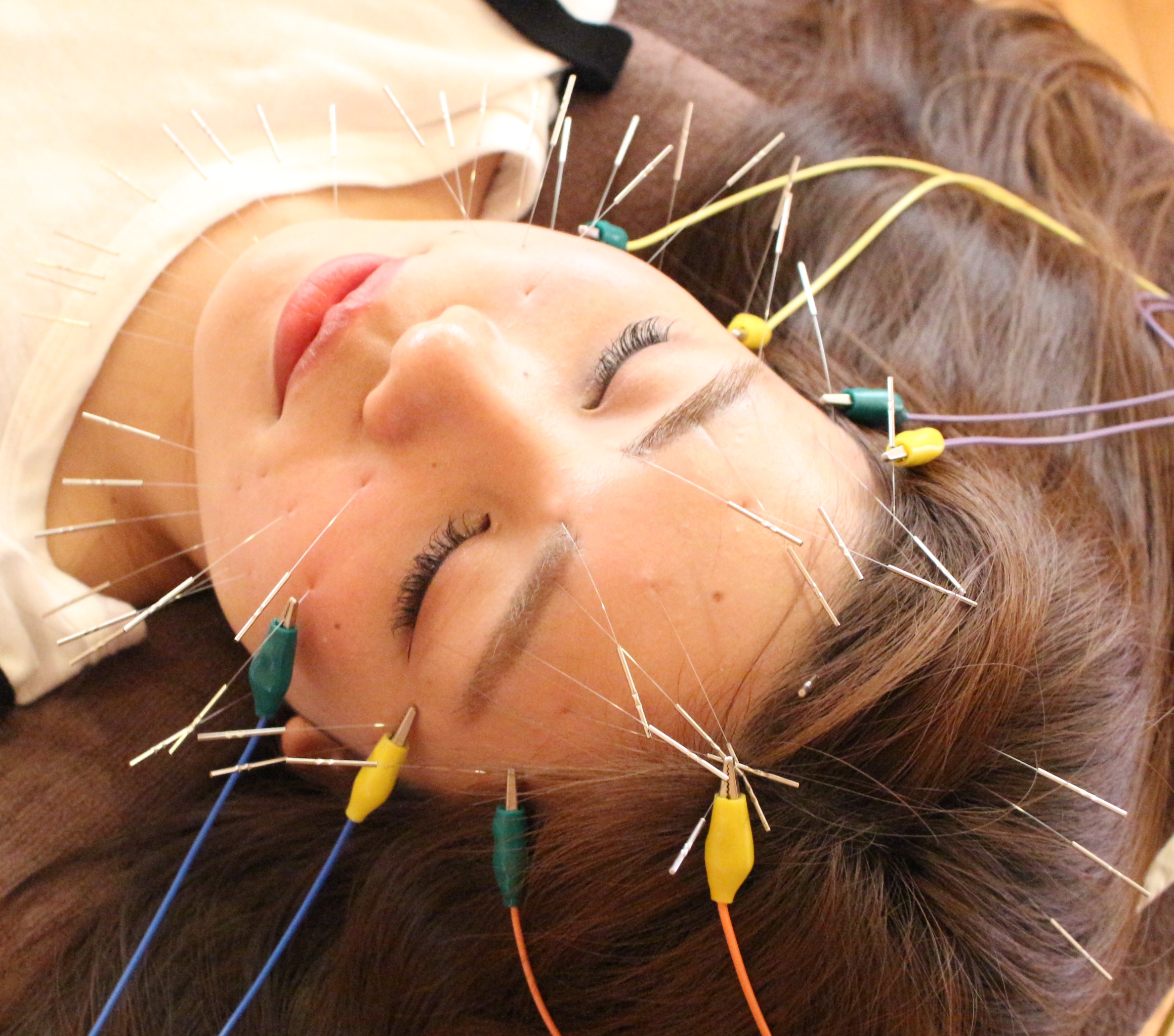 鍼灸マッサージ・美容鍼・ダイエット　藤井治療院 （初診）電気を全体に流す美容鍼（Cコース）のメニュー画像