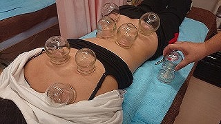國安鍼灸整骨院　中野院 カッピング/吸玉（鍼灸併用）のメニュー画像