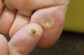 國安鍼灸整骨院　中野院 魚の目のお灸　一部位のメニュー画像