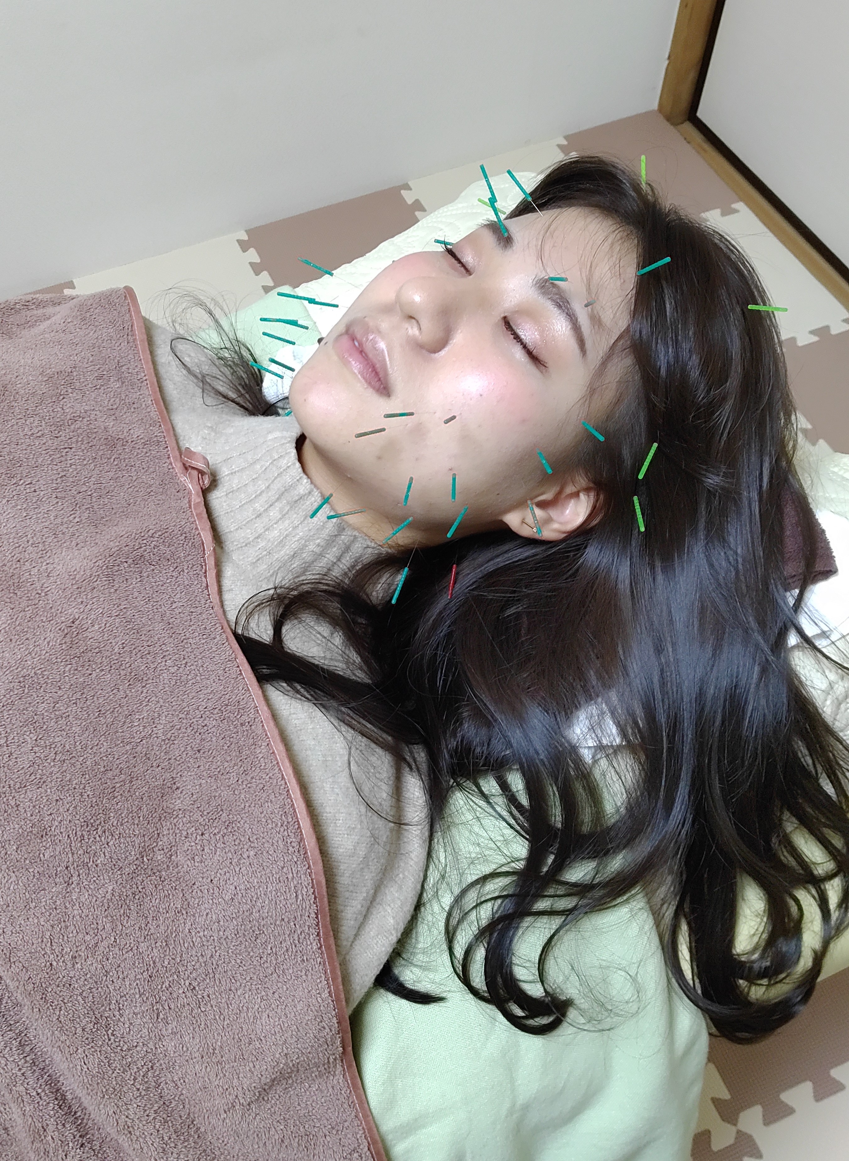 鍼灸治療院ハセガワ本院 『初回』美容鍼施術　３０分のメニュー画像