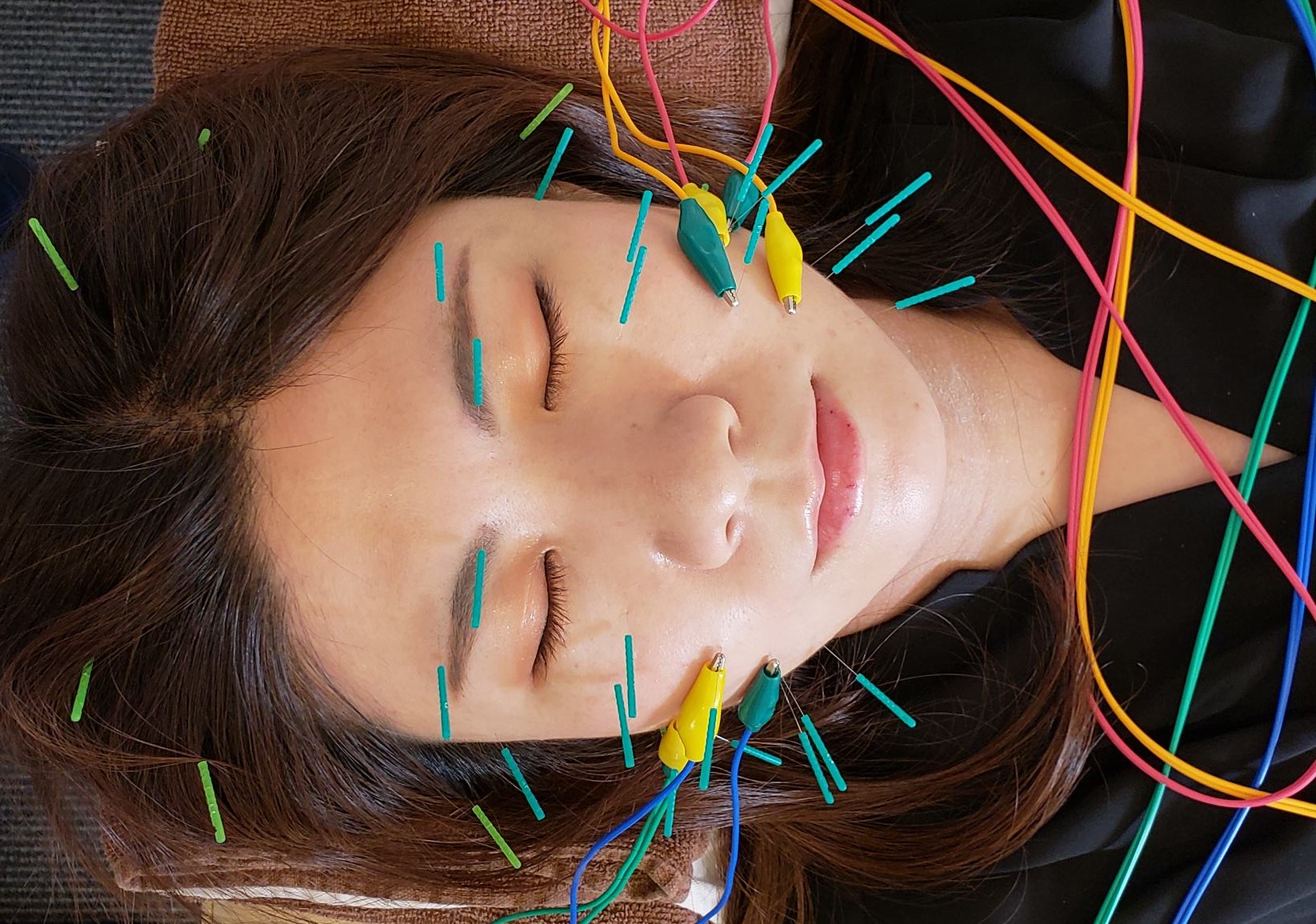 鍼灸治療院ハセガワ本院 『初回』美容鍼施術　６０分のメニュー画像