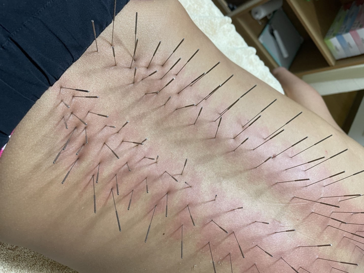 葵の葉鍼灸院 【オーダーメイド施術】ルート治療 60分のメニュー画像