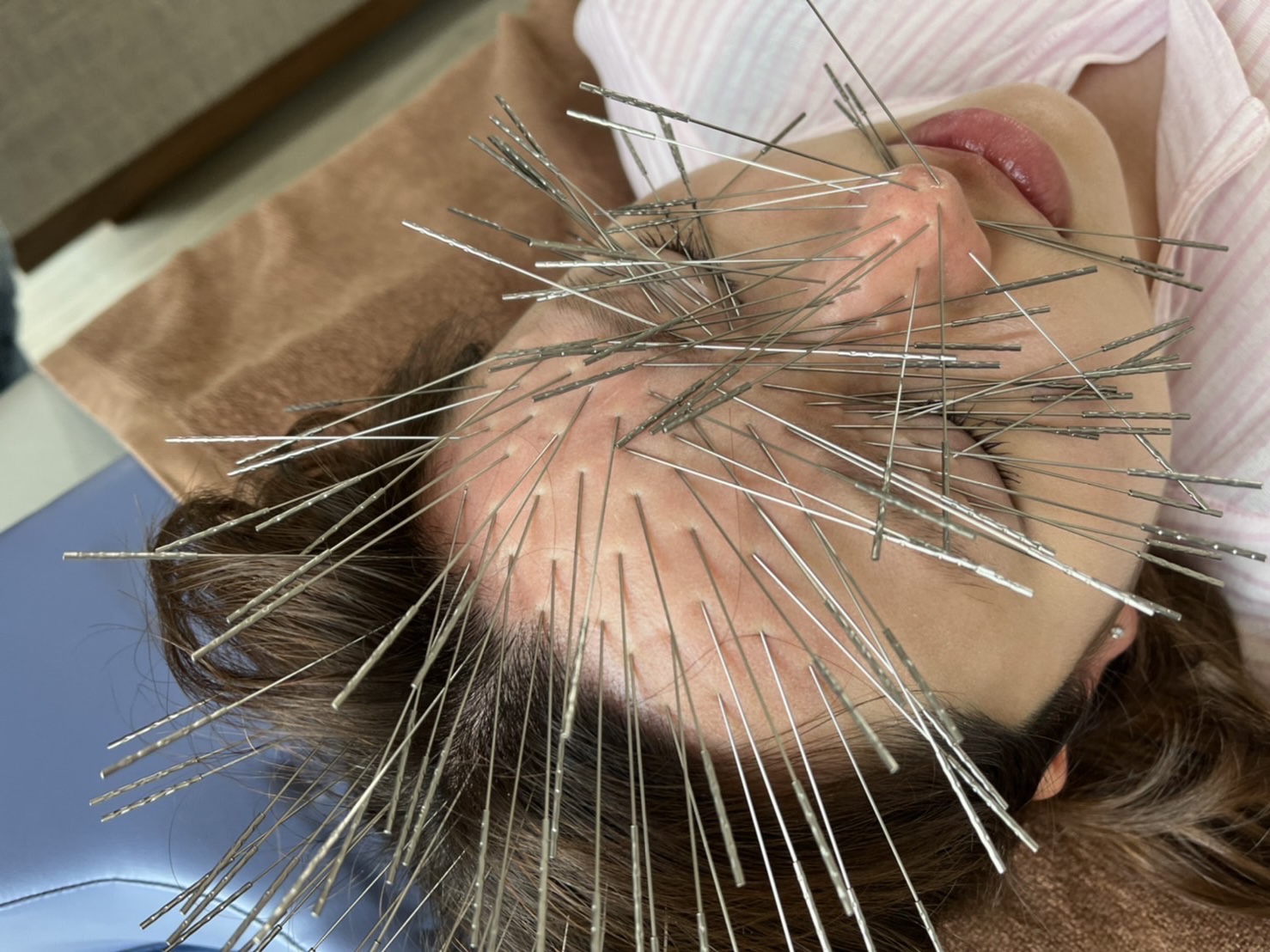 葵の葉鍼灸院 【シワ・たるみ改善！驚異の小顔効果】ルート美容鍼のメニュー画像