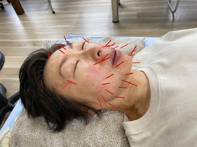 美容鍼灸・整体サロンaquliss aquliss美顔鍼のメニュー画像