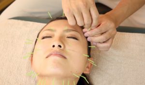 ひじり総合治療院 /鍼灸/整体　新瑞橋 初回　美容鍼　　のメニュー画像