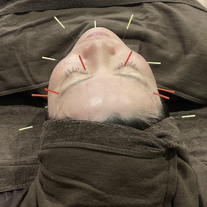 鍼灸アロマサロン花水樹 【初回限定】健康美容鍼 60分のメニュー画像