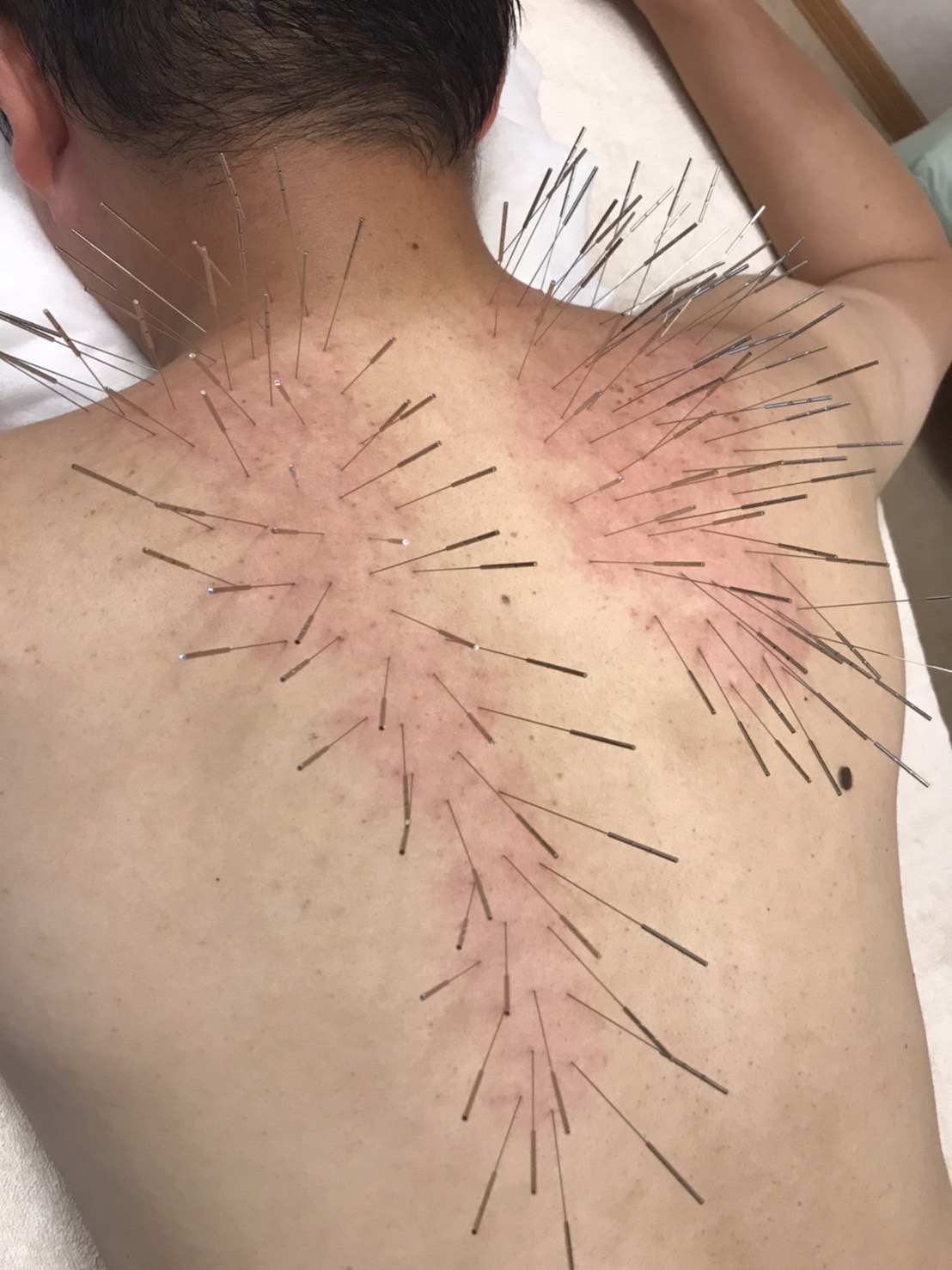 鍼灸マッサージ　蒲田のむすび ルート治療のメニュー画像