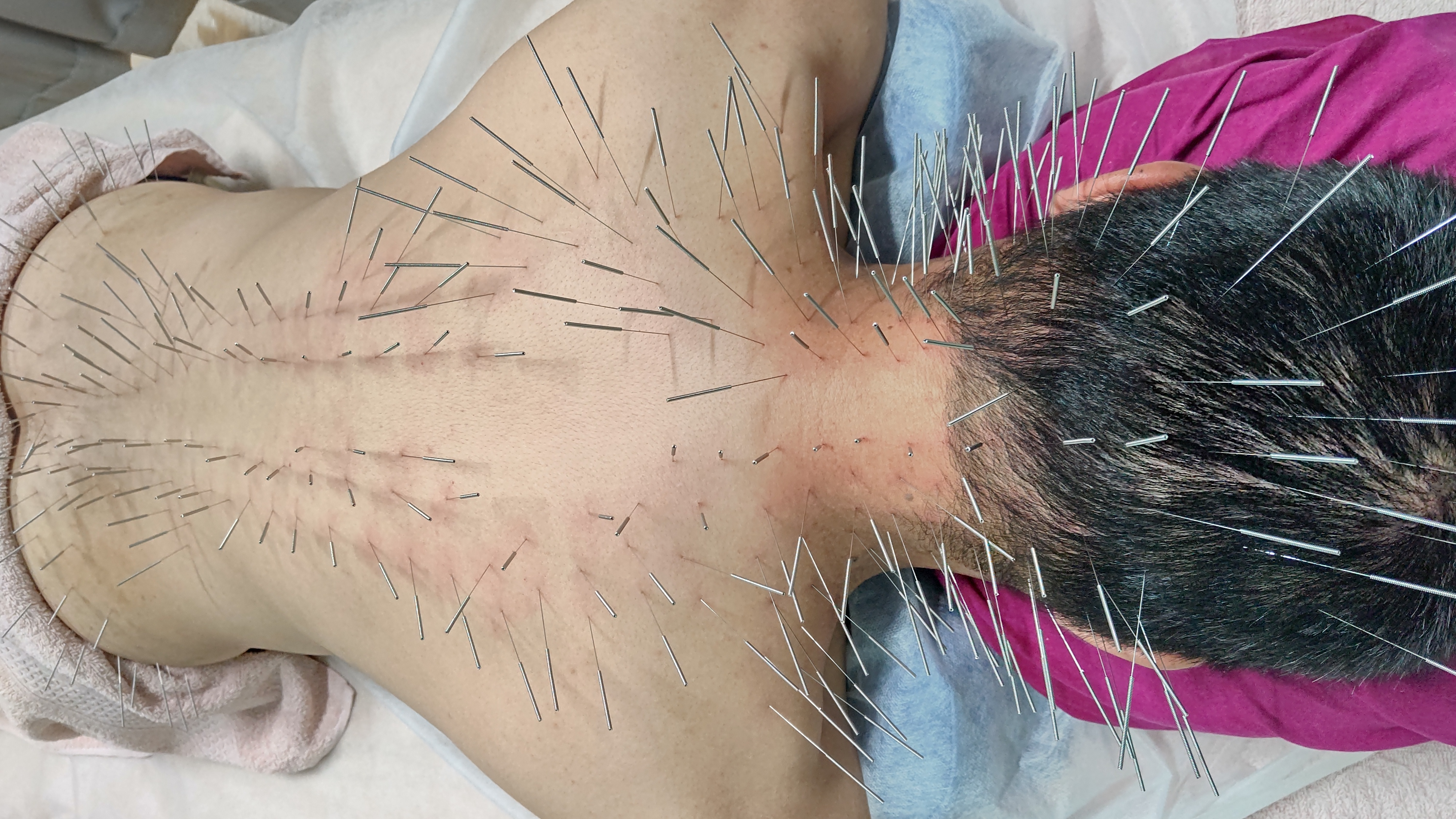 鍼灸マッサージ　蒲田のむすび 初回　ルート治療のメニュー画像