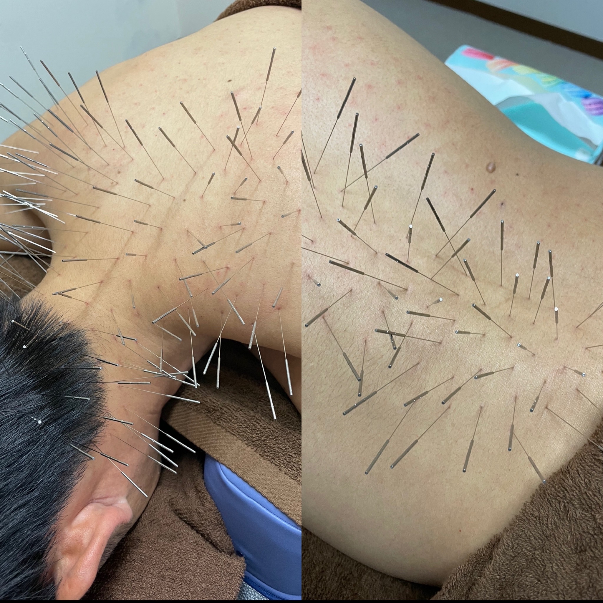 鍼処SHIRAKAWA 浦和院 ルート鍼治療　60分のメニュー画像