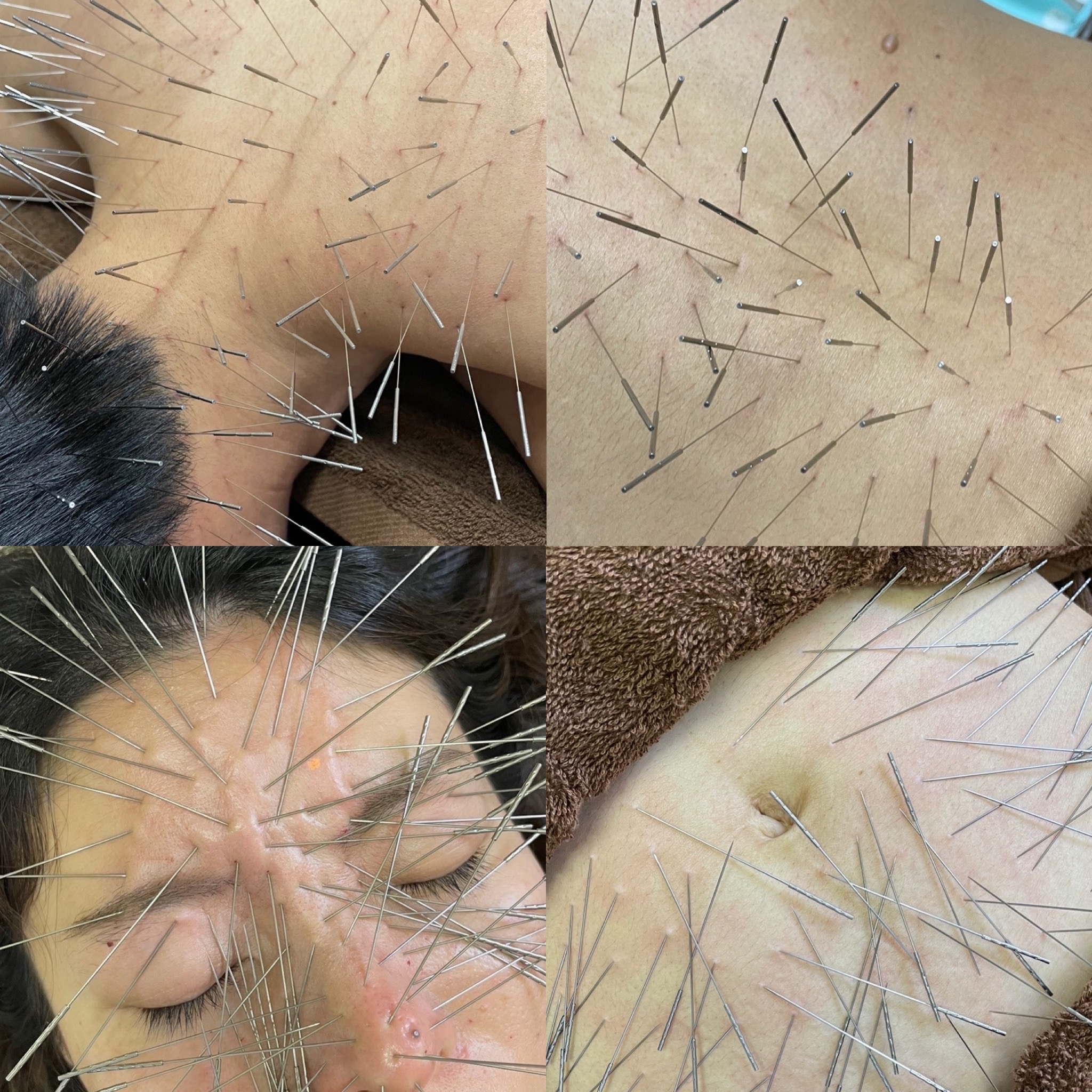 鍼処SHIRAKAWA 浦和院 ルート鍼治療　90分のメニュー画像