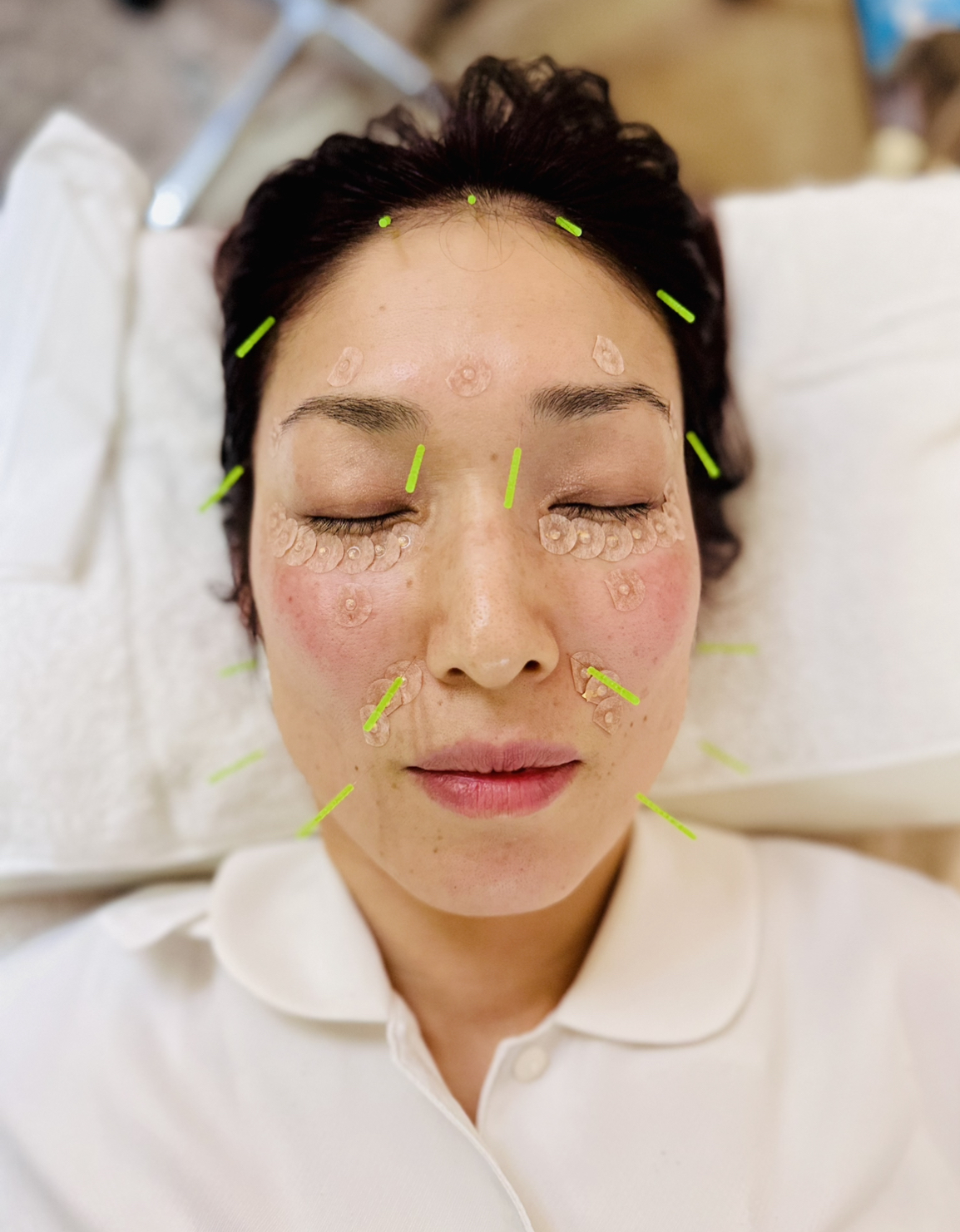 整体・鍼灸サロンAnon リフトアップ美容鍼 (埋金美顔鍼＋幹細胞上清液＋パルス)のメニュー画像