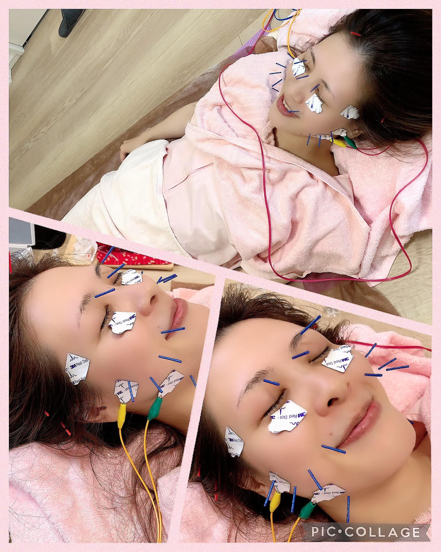 あゆ鍼灸治療院　女性と子ども専門はりきゅう 低周波美容鍼de小顔リフトアップのメニュー画像