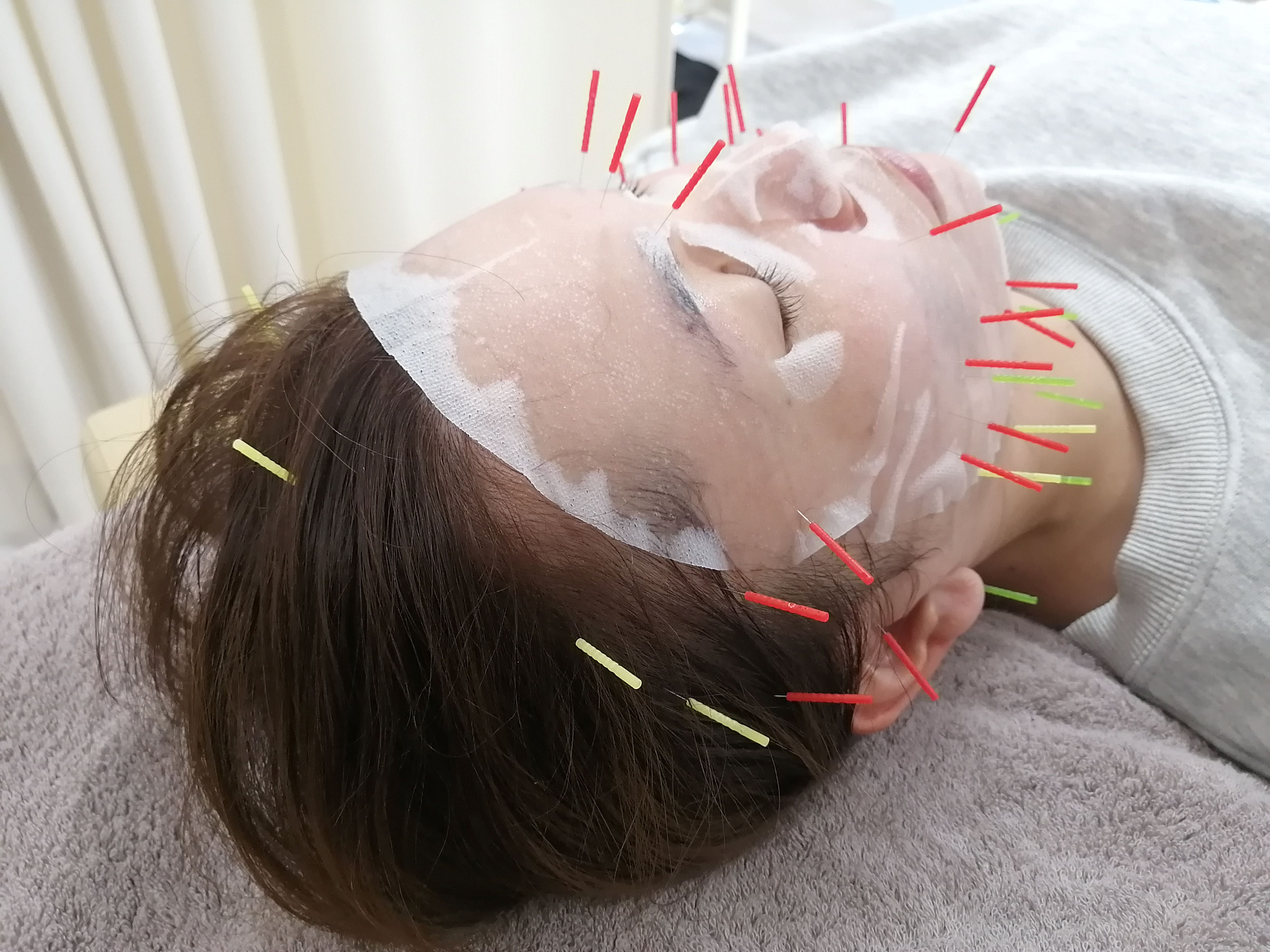 Acure鍼灸整体サロン ＜九州でも希少な＞ヒト幹細胞美容鍼のメニュー画像