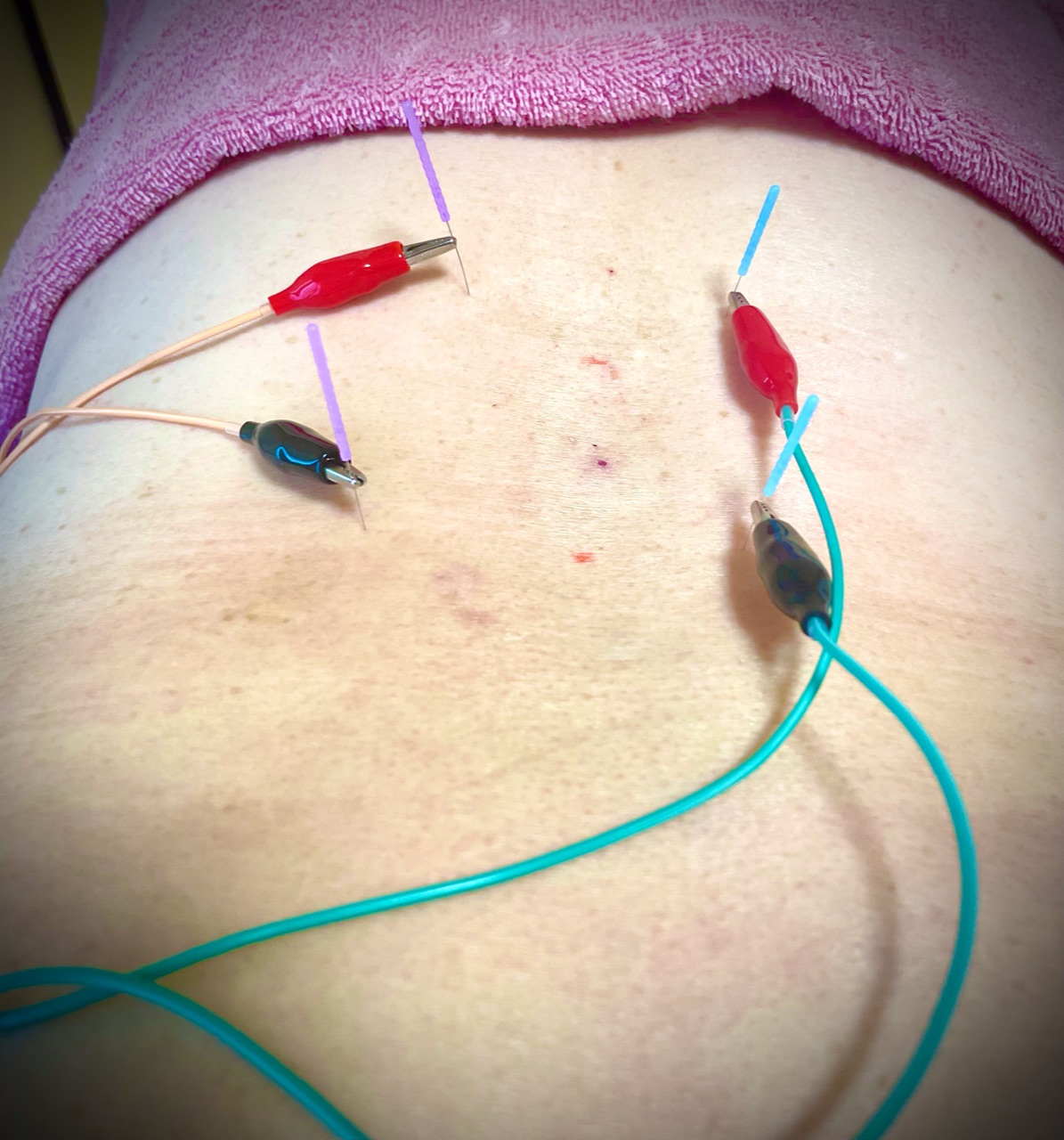 月ノ火鍼灸院 局所鍼治療(当院初めての方用で初見料込みです）のメニュー画像