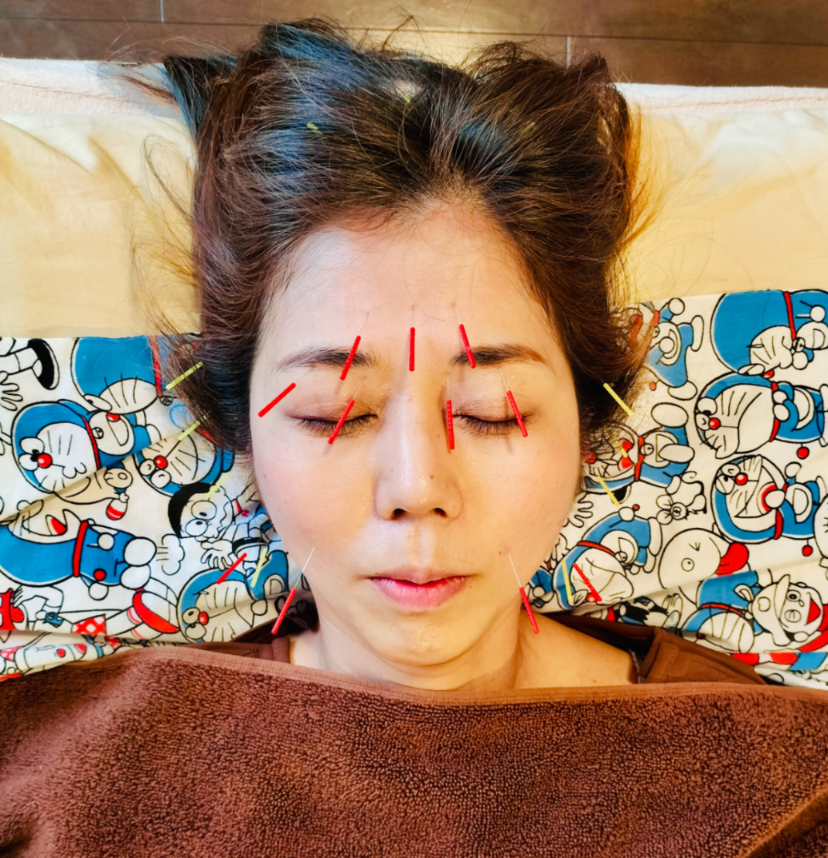 女性のための小さな治療室　はり・きゅう　よもぎ庵 【初診】お試しスペシャル美容鍼のメニュー画像