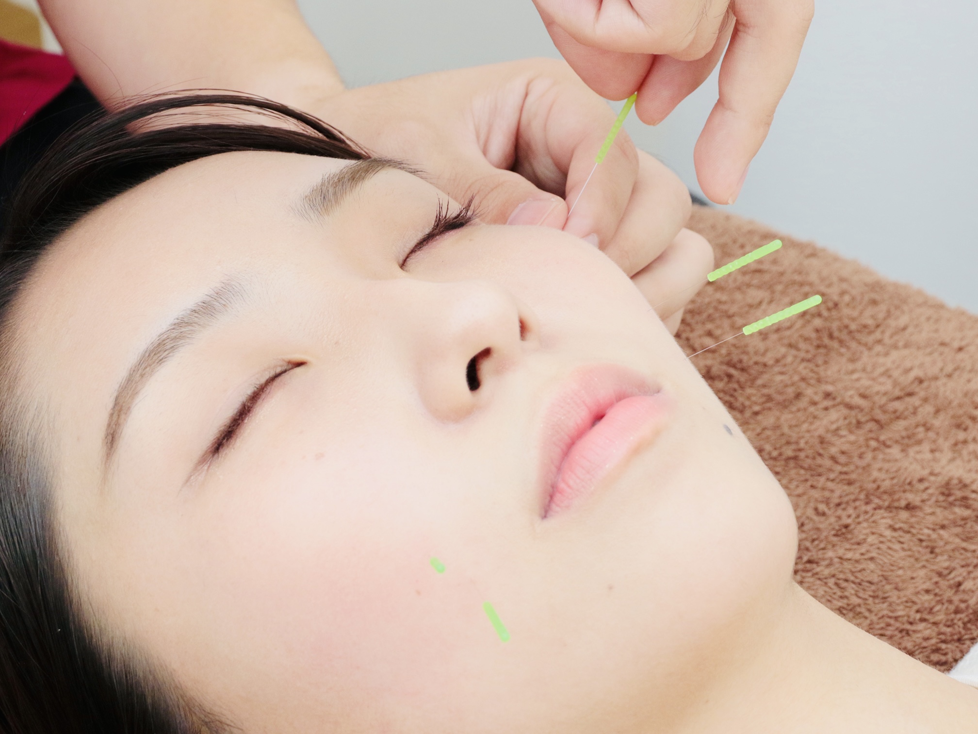 小林整骨院　立花 小顔特化美容鍼【スタンダード】のメニュー画像