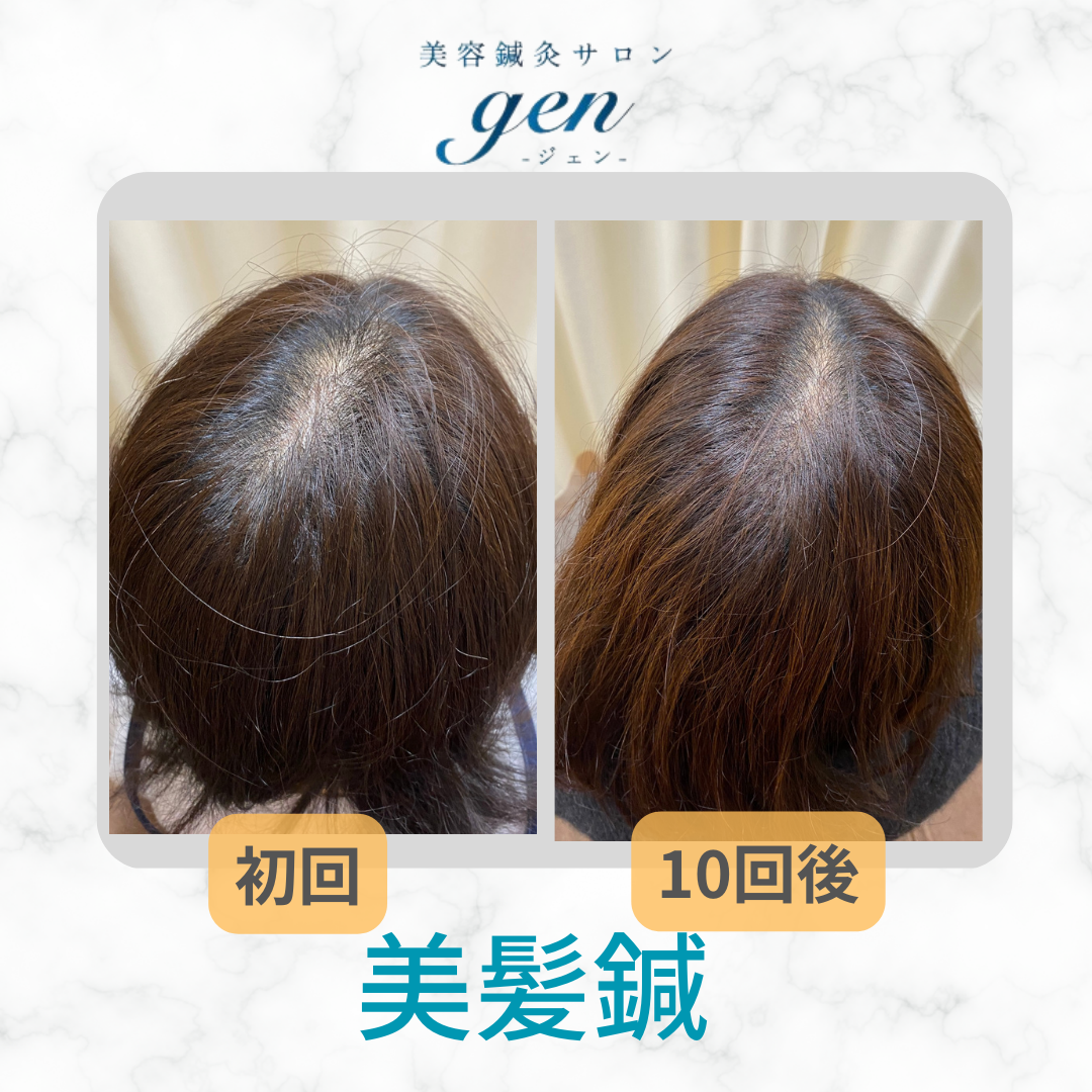 美容鍼灸サロンgen-ジェン- 髪の悩みにオススメ！美髪鍼(育毛鍼)のメニュー画像