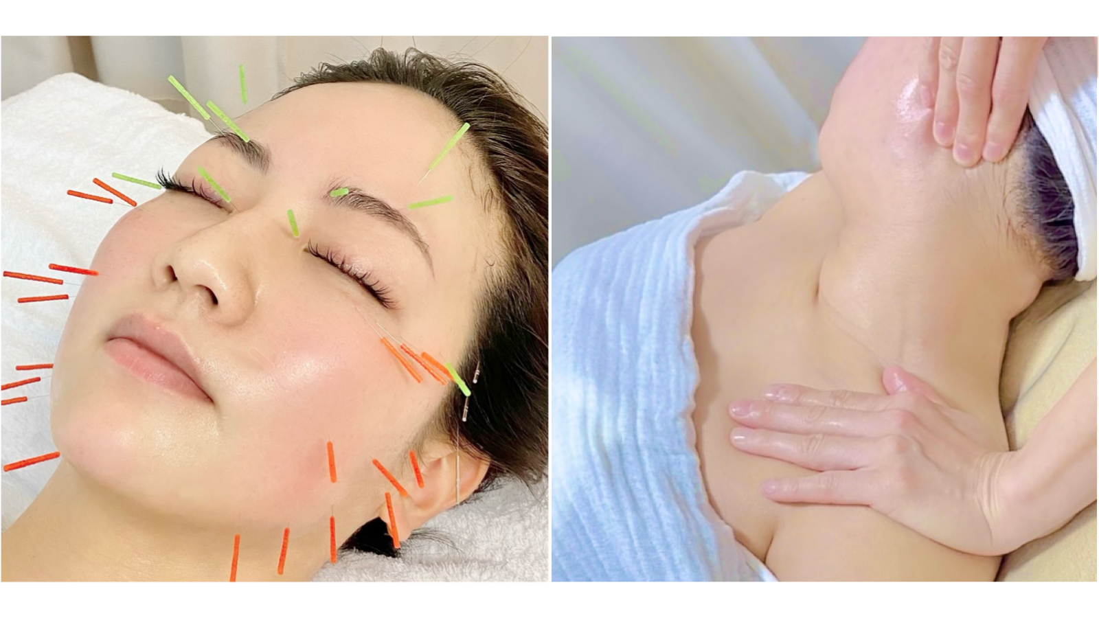 たるみ専門 美容鍼灸 アルバ 美容鍼灸プラスのメニュー画像