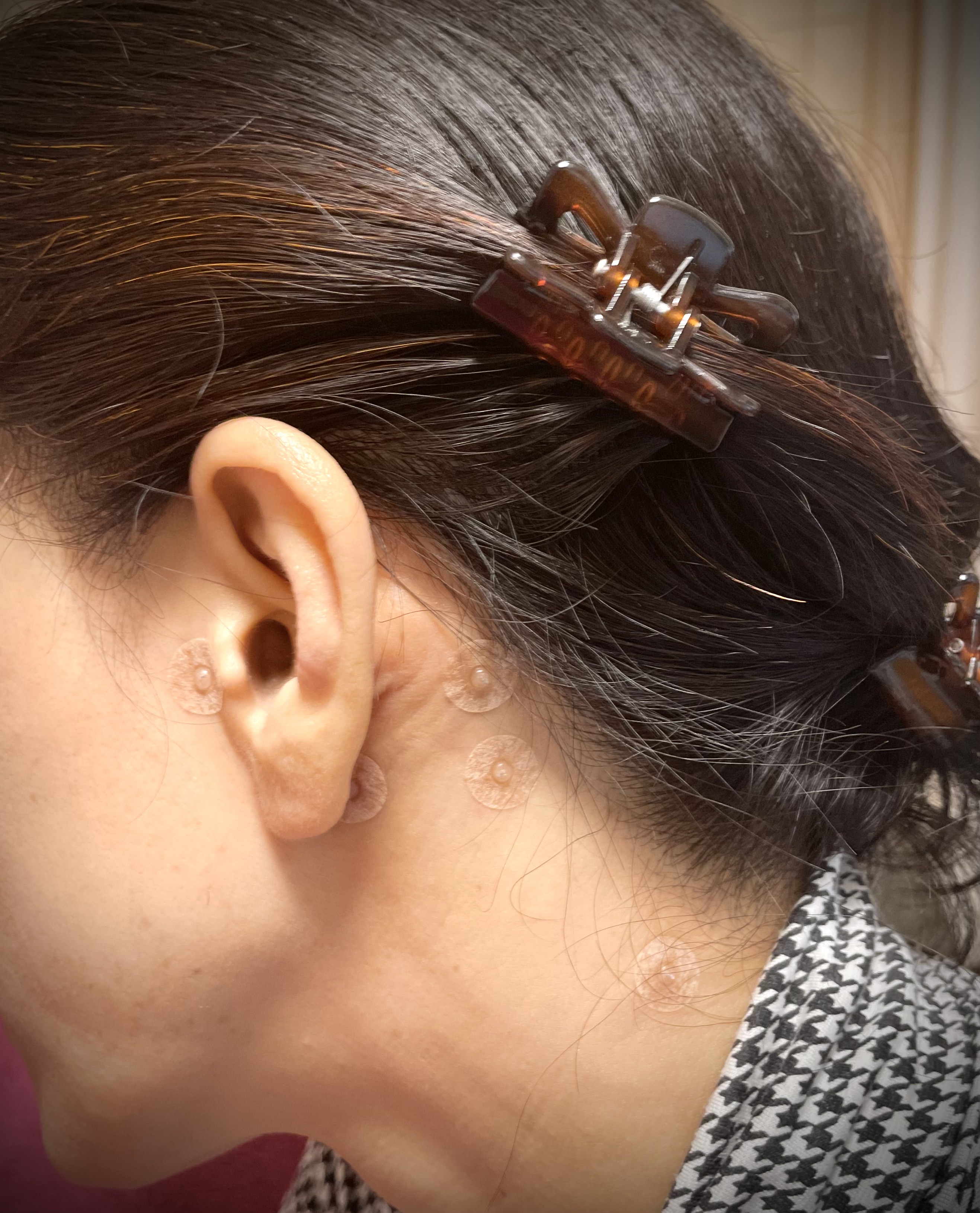 月ノ火鍼灸院 置き鍼治療(当院初めての方）のメニュー画像