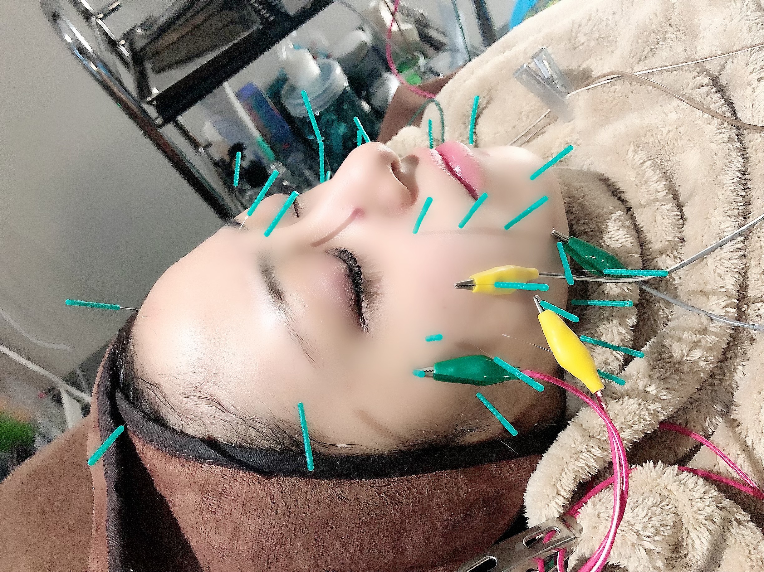 セントラル鍼灸院Re:laxy パルス美容鍼　人気No❷（くすみに透明感アップ）17600が２回目からもお得！のメニュー画像