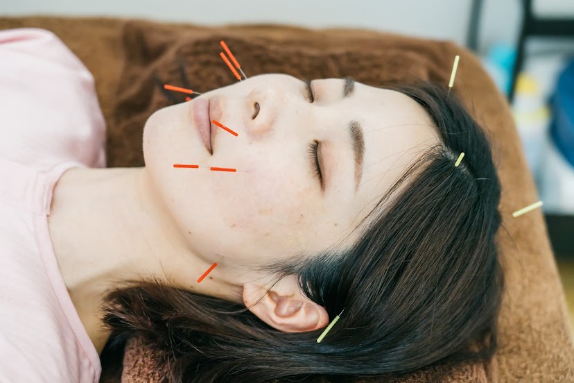 女性のための鍼灸院　teate（テアテ） 【2回目以降】美容鍼＋からだの鍼灸のメニュー画像