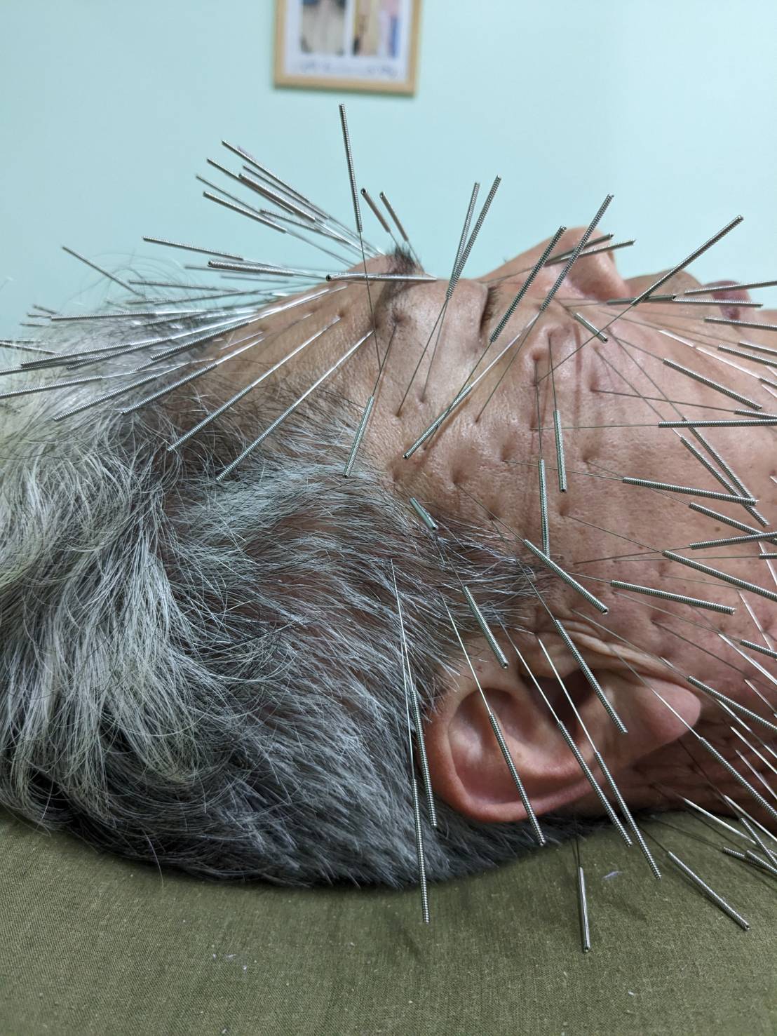 鍼灸マッサージ　蒲田のむすび ルート鬼美容鍼のメニュー画像