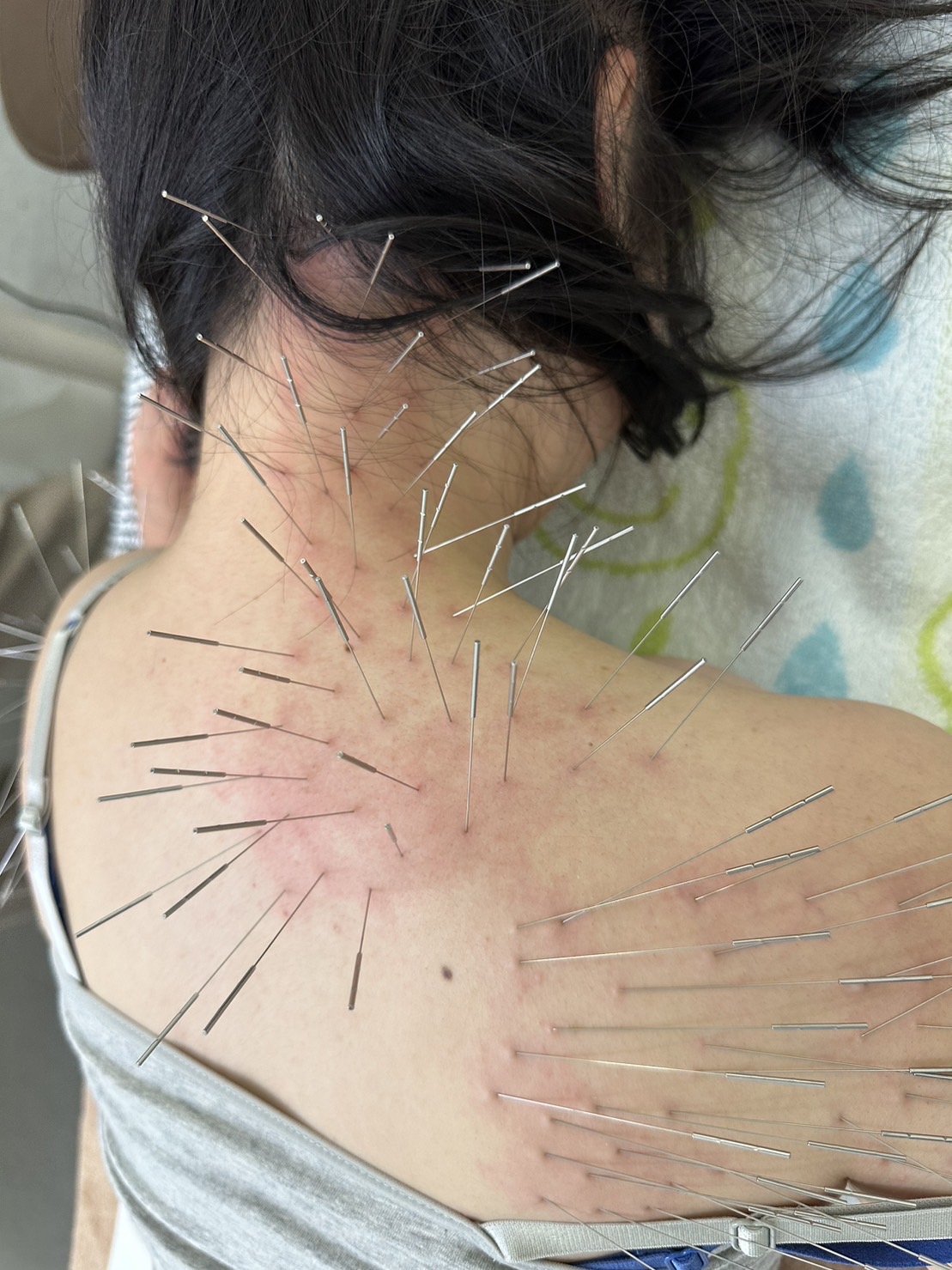 赤石はり・きゅう治療院 【初回】ルート治療30のメニュー画像