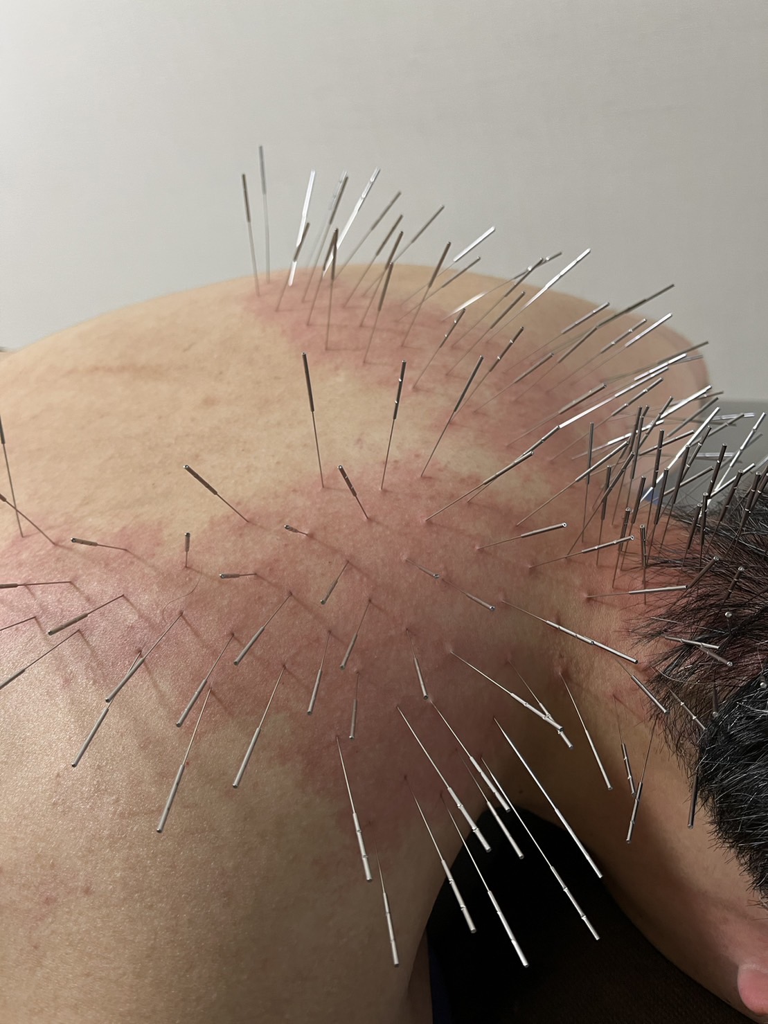 赤石はり・きゅう治療院 【2回目以降】ルート治療30のメニュー画像