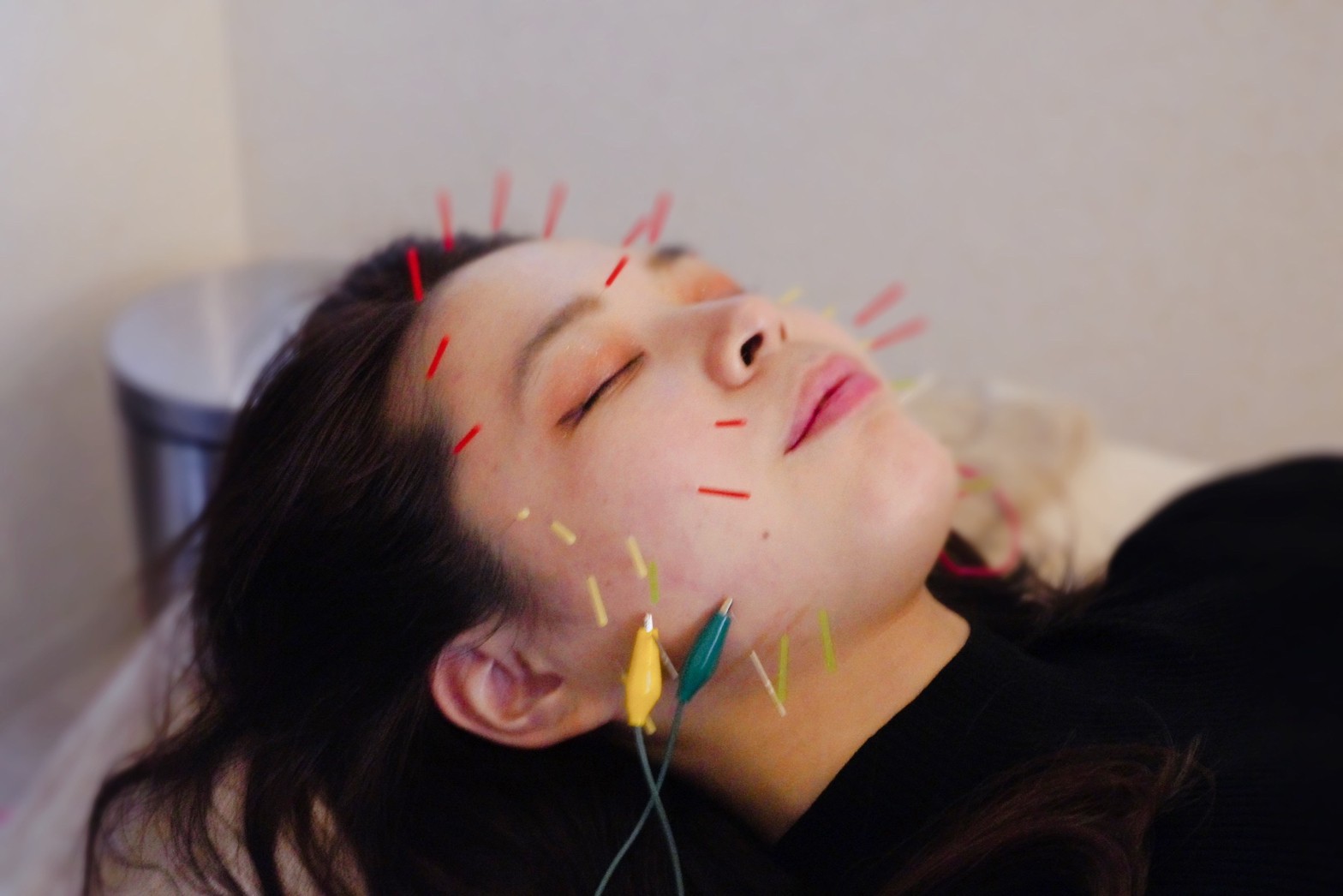 鍼灸ルミナス リフトアップコース のメニュー画像