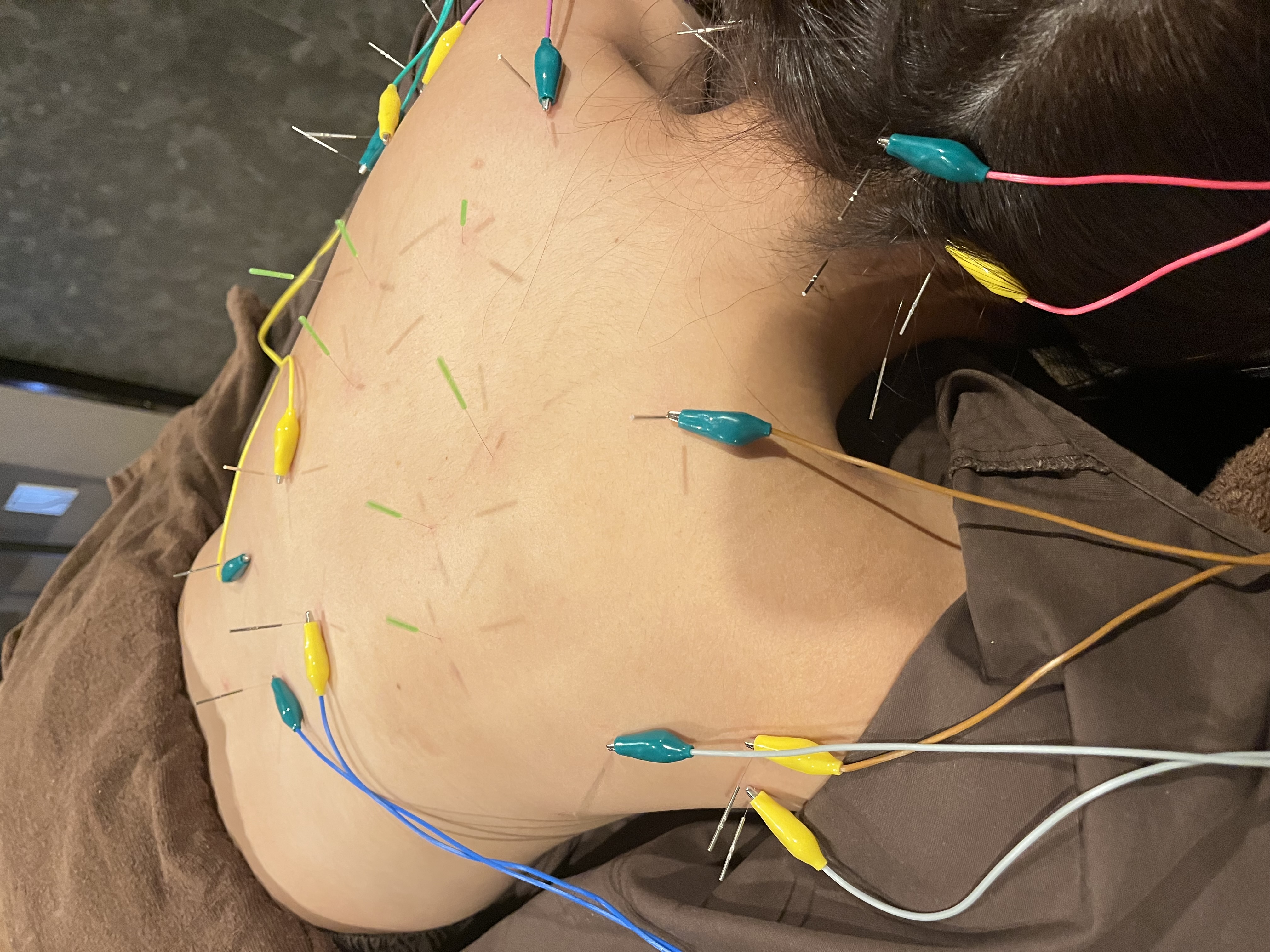 美容鍼灸院　HARI美癒 背部治療60分のメニュー画像