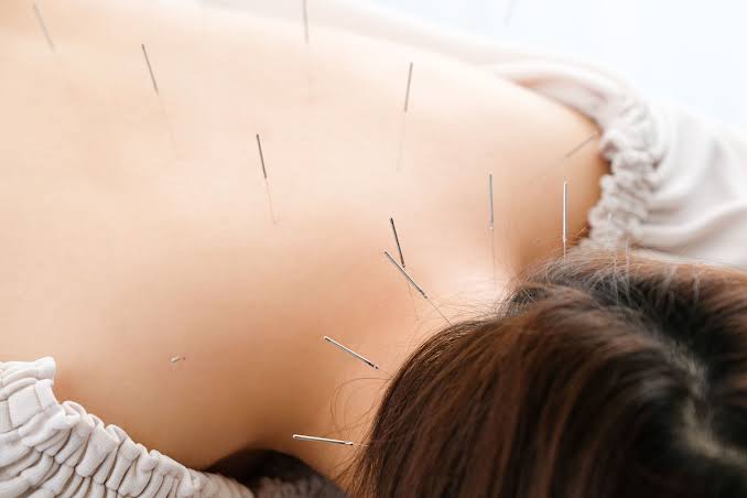 美容鍼灸サロンgen-ジェン- 体の鍼治療のメニュー画像
