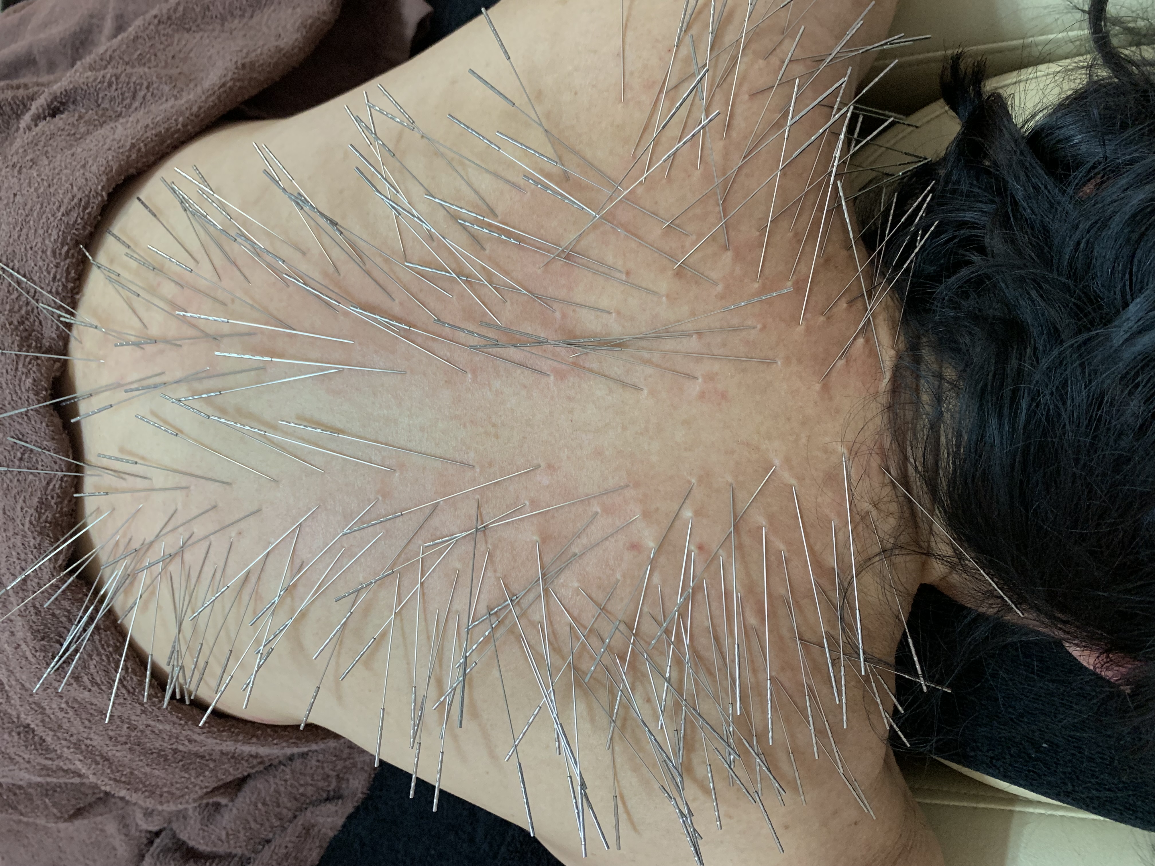 たまがわ鍼灸院(ルート治療) ルート鍼治療60分のメニュー画像