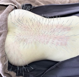 ルート治療専門　ながえ鍼灸院 ルート治療６０分（全身治療or局所治療＋鬼美容鍼or発毛ルート治療）のメニュー画像