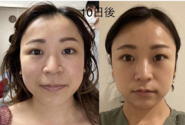 長﨑鍼療院【ルート治療認定院】 ルート鬼美容鍼（モニター様専用）のメニュー画像