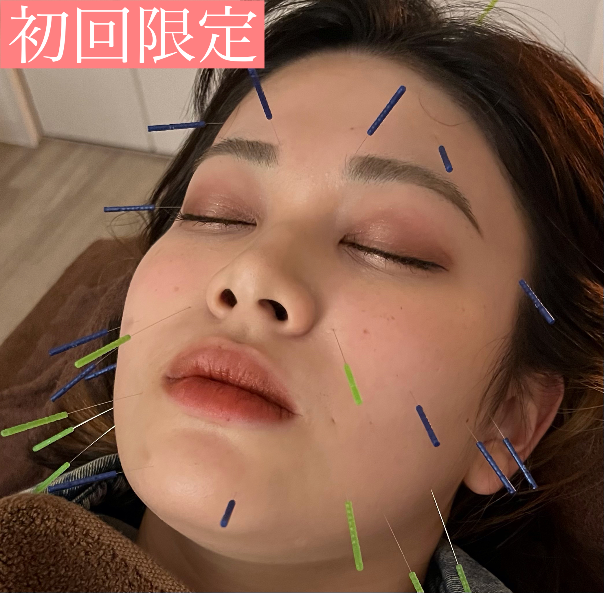鍼灸サロンLieN 【初回限定】ベーシック美容鍼灸コースのメニュー画像