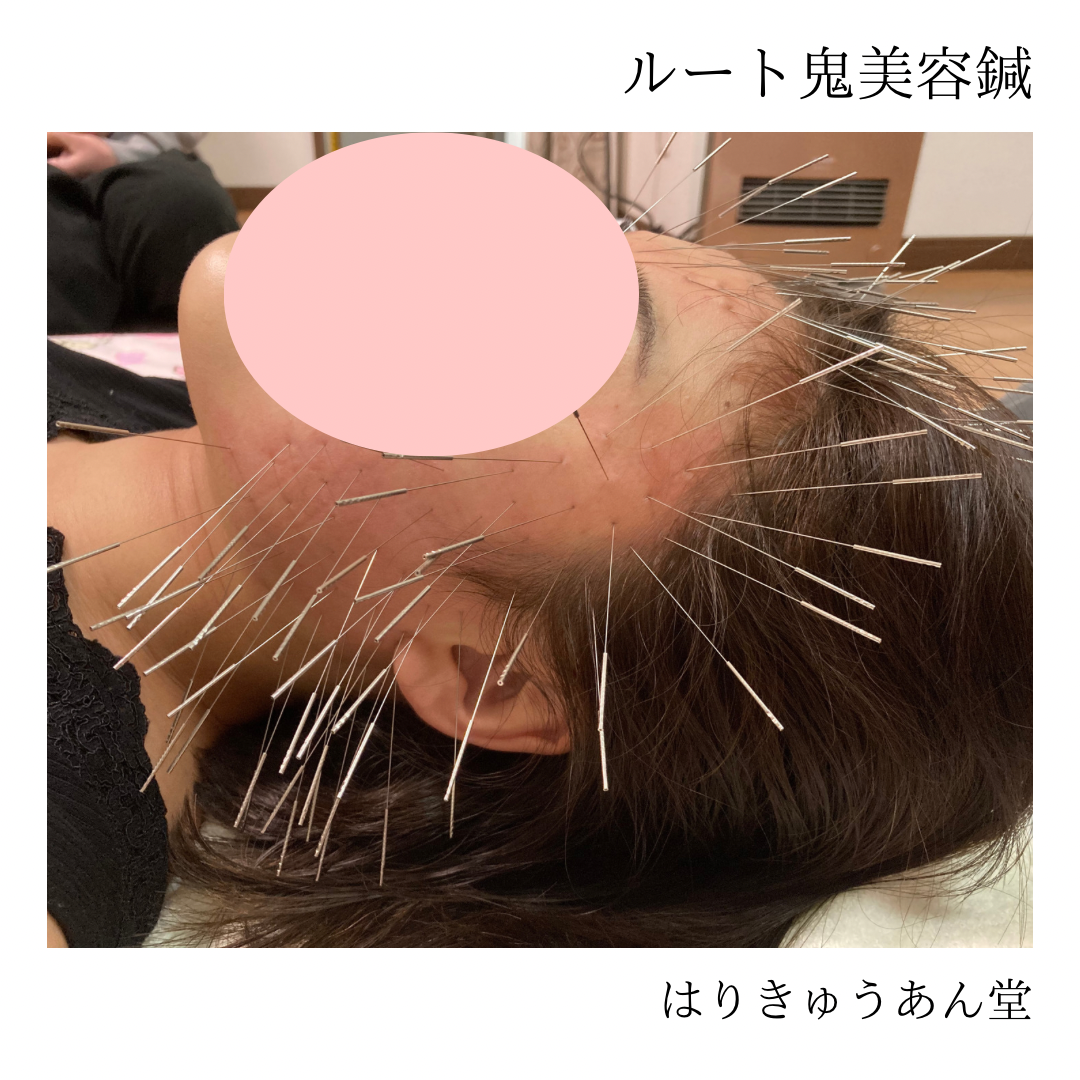 はりきゅうあん堂【ルート治療｜女性専用】 ルート鬼美容鍼60分コースのメニュー画像