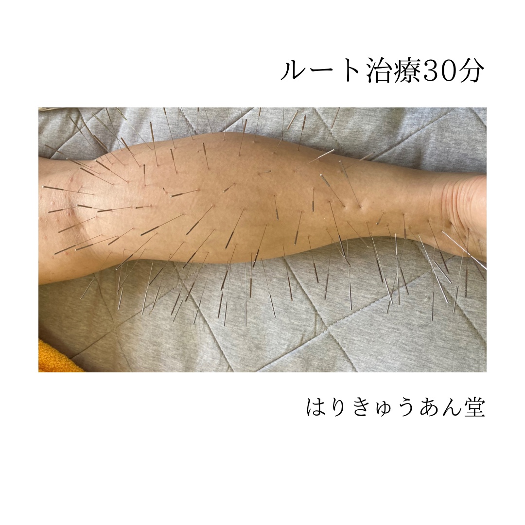 はりきゅうあん堂【ルート治療｜女性専用】 ルート治療30分のメニュー画像