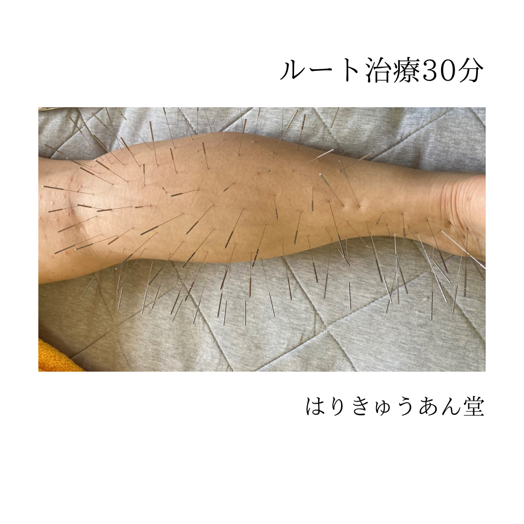 はりきゅうあん堂｜ルート治療 ルート治療30分のメニュー画像