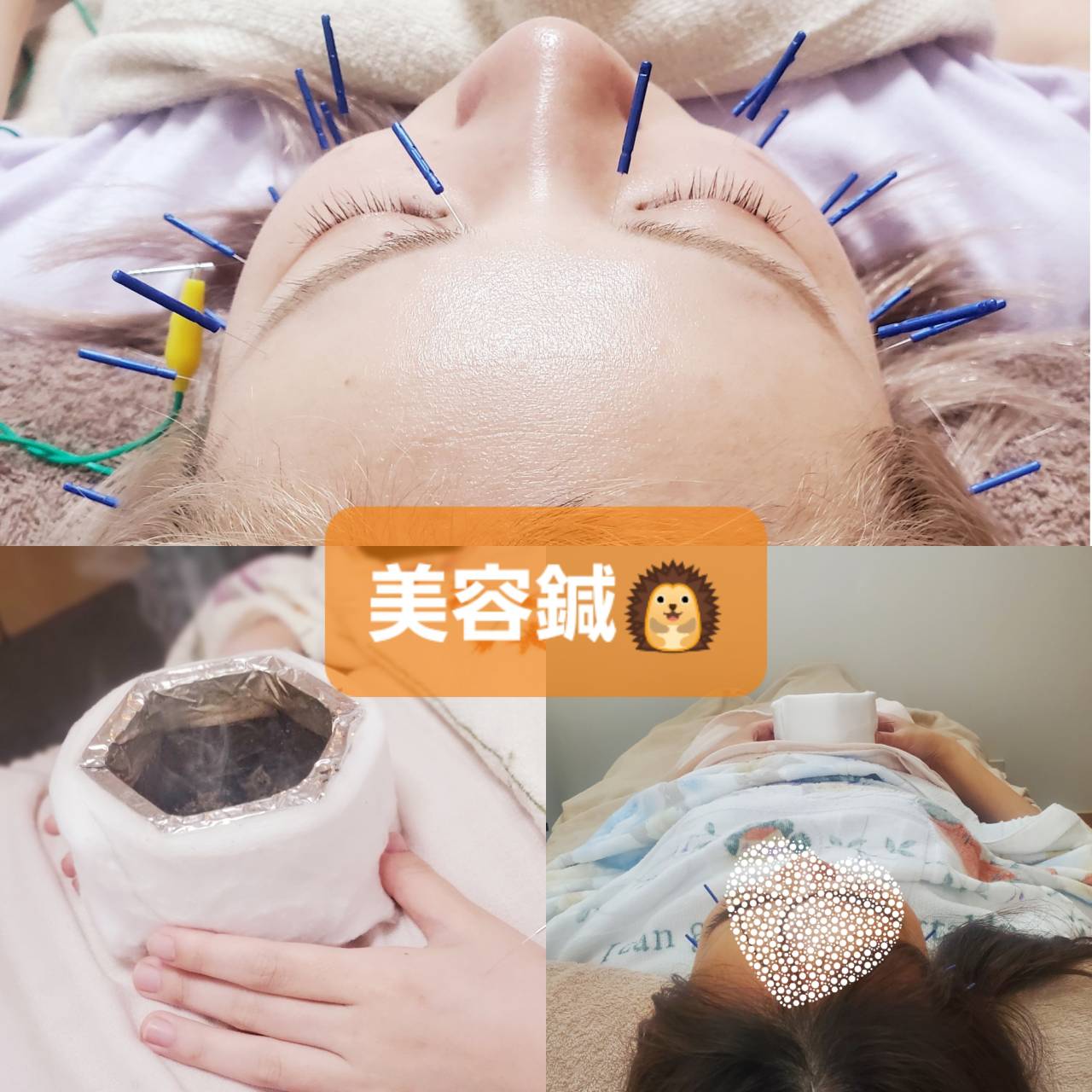 茉莉はりきゅう院 オプションメニュー ☆美容鍼 ライトのメニュー画像