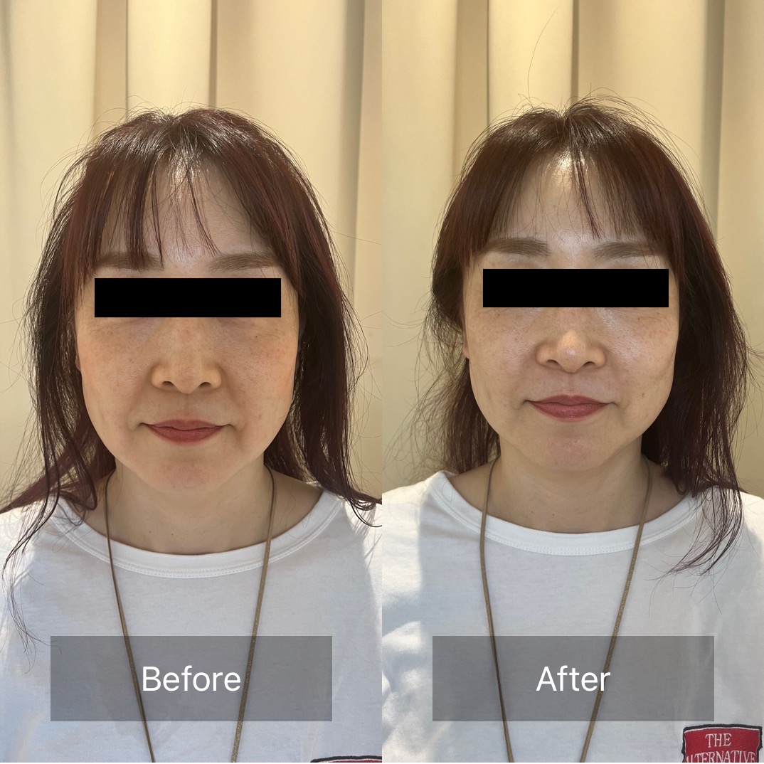 樹はりきゅう・整体院 樹式小顔矯正　初回限定価格　通常9,900のメニュー画像