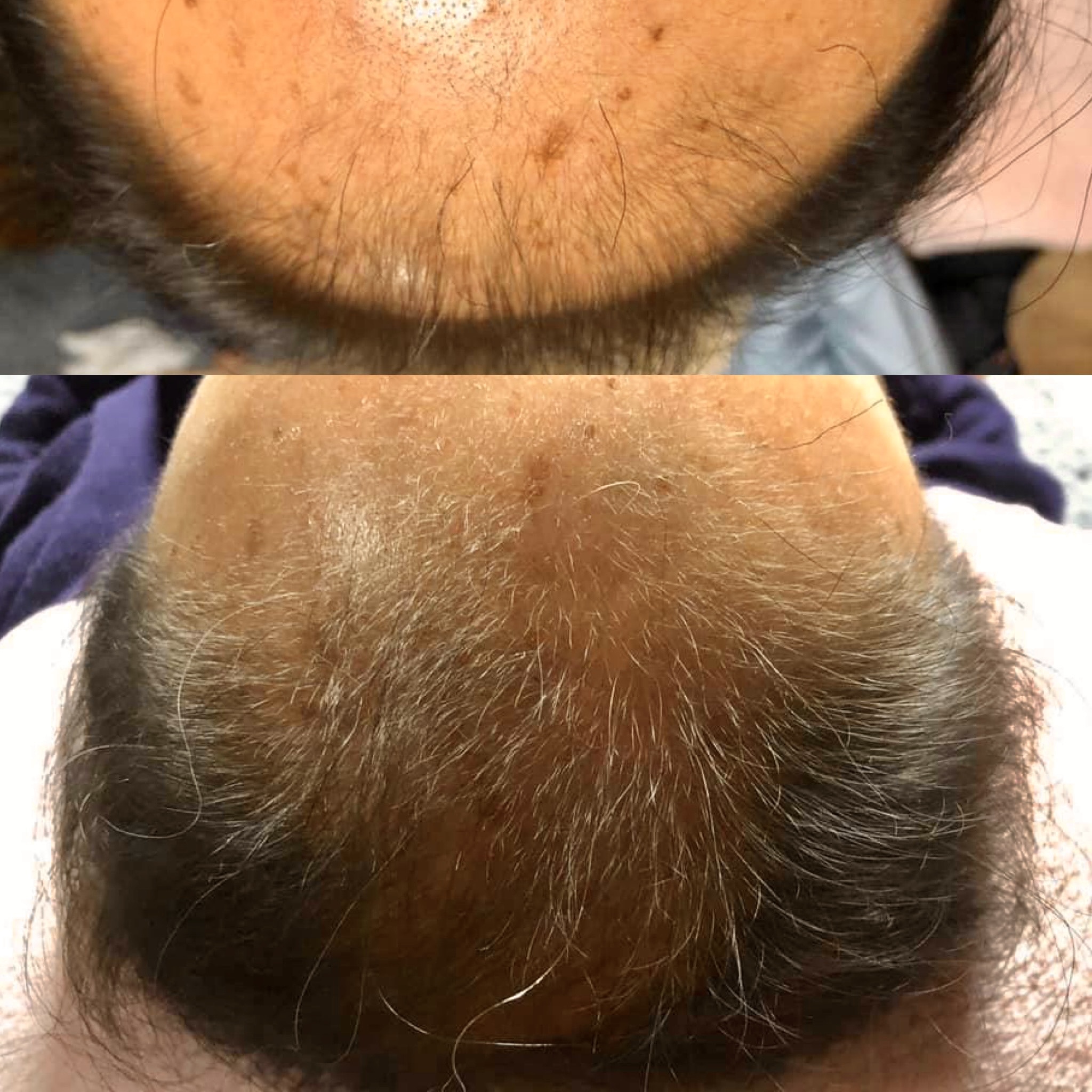 月陽堂鍼灸治療院 薄毛治療60（頭皮＋身体）のメニュー画像