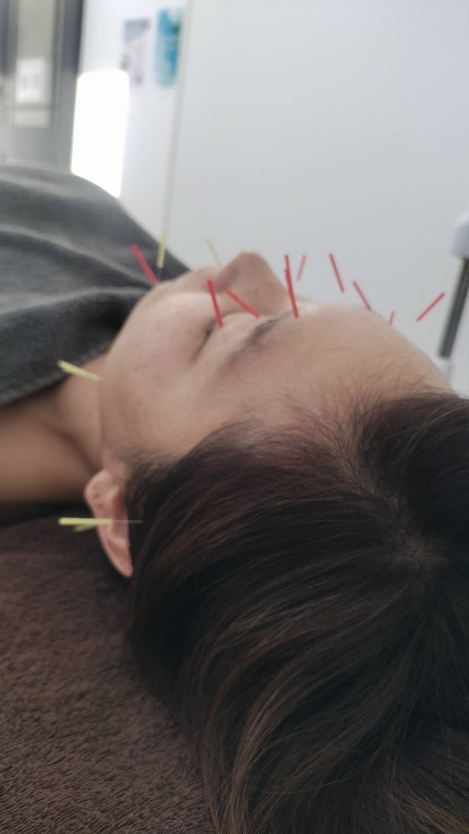 リラクゼーション鍼灸 HARIOKA 【初回】美容鍼スタンダードコースのメニュー画像