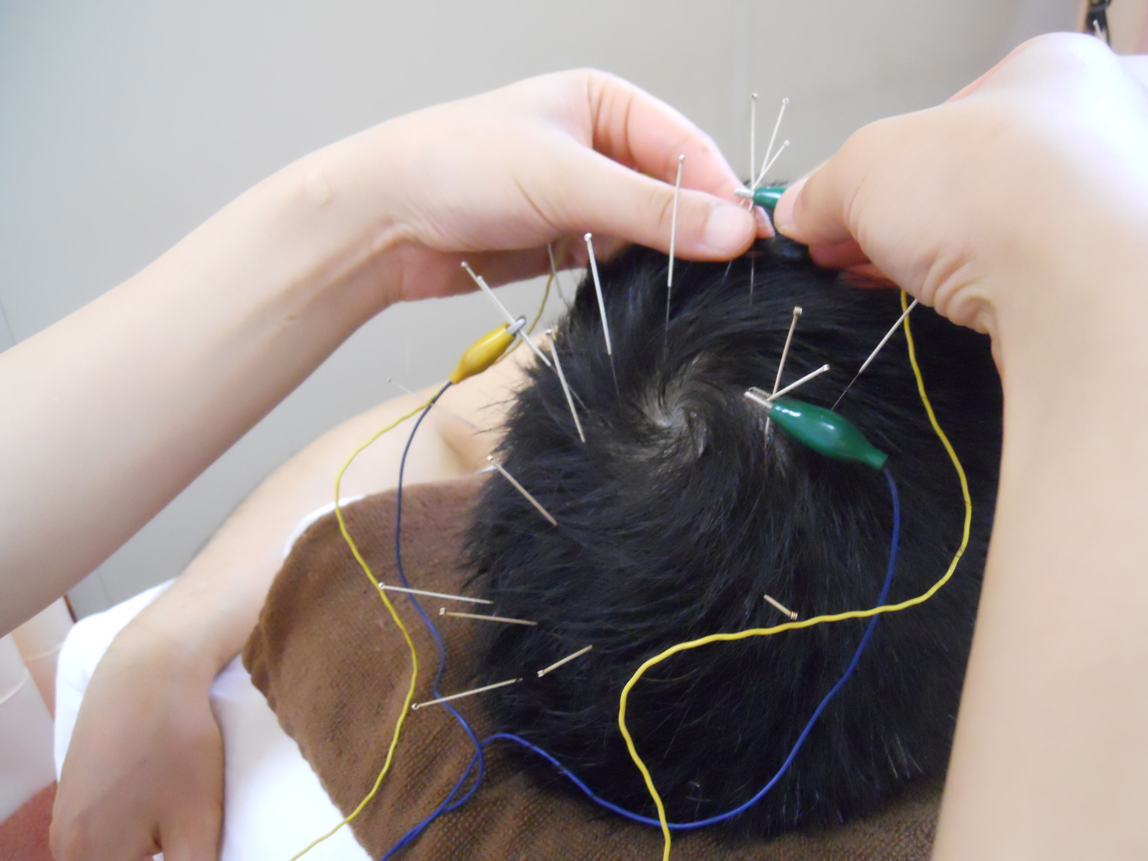 大阪 前田鍼灸院　（旧：前田針灸接骨院） 【初診】大人針灸治療のメニュー画像