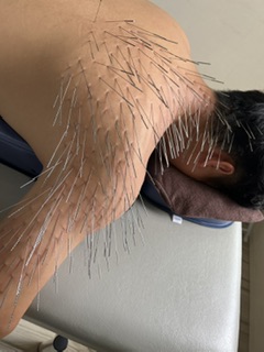 長﨑鍼療院【ルート治療認定院】 ルート治療(スタンダード)  のメニュー画像