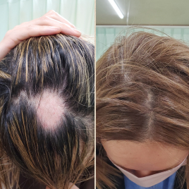 リズム鍼灸マッサージ院 BH（育毛の鍼）のメニュー画像