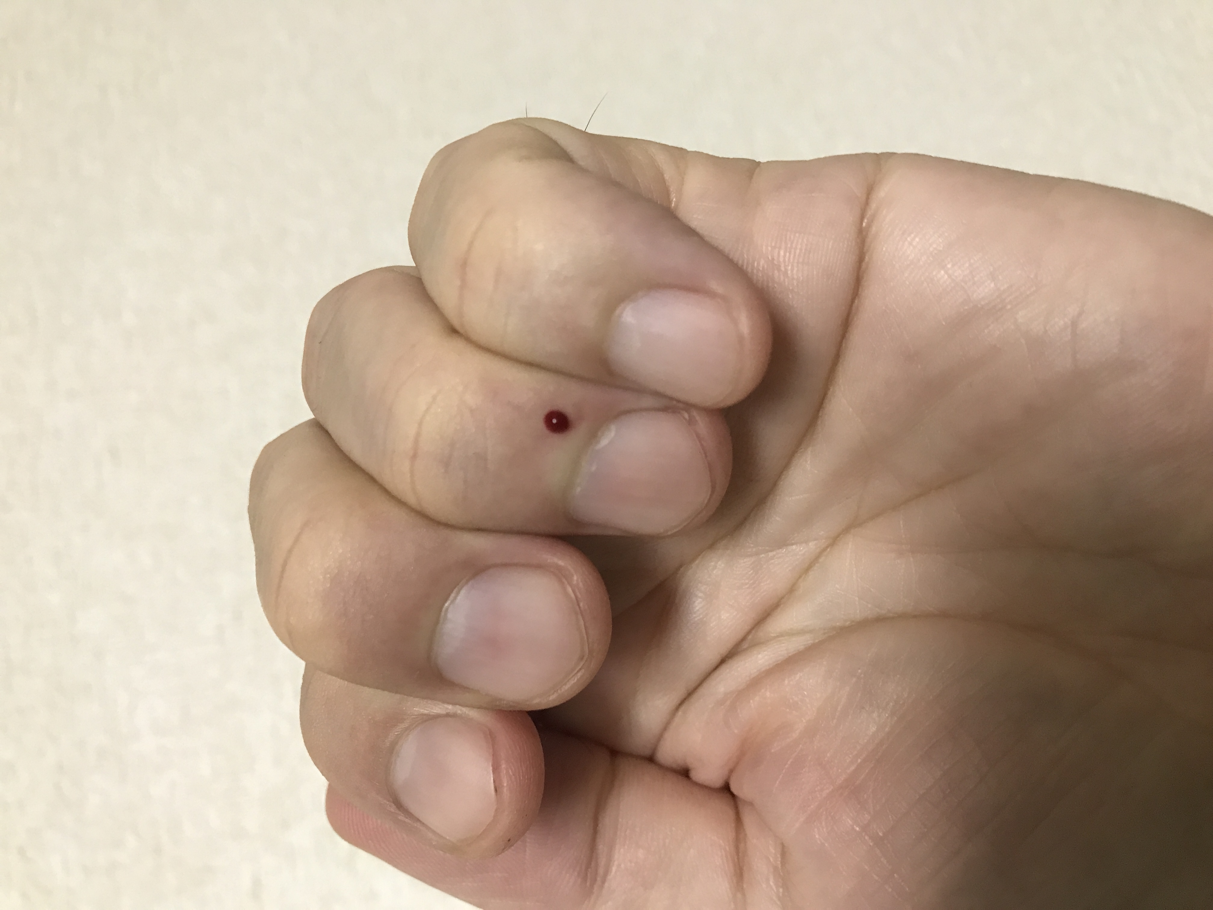アキラ鍼灸院 井穴刺絡療法のメニュー画像