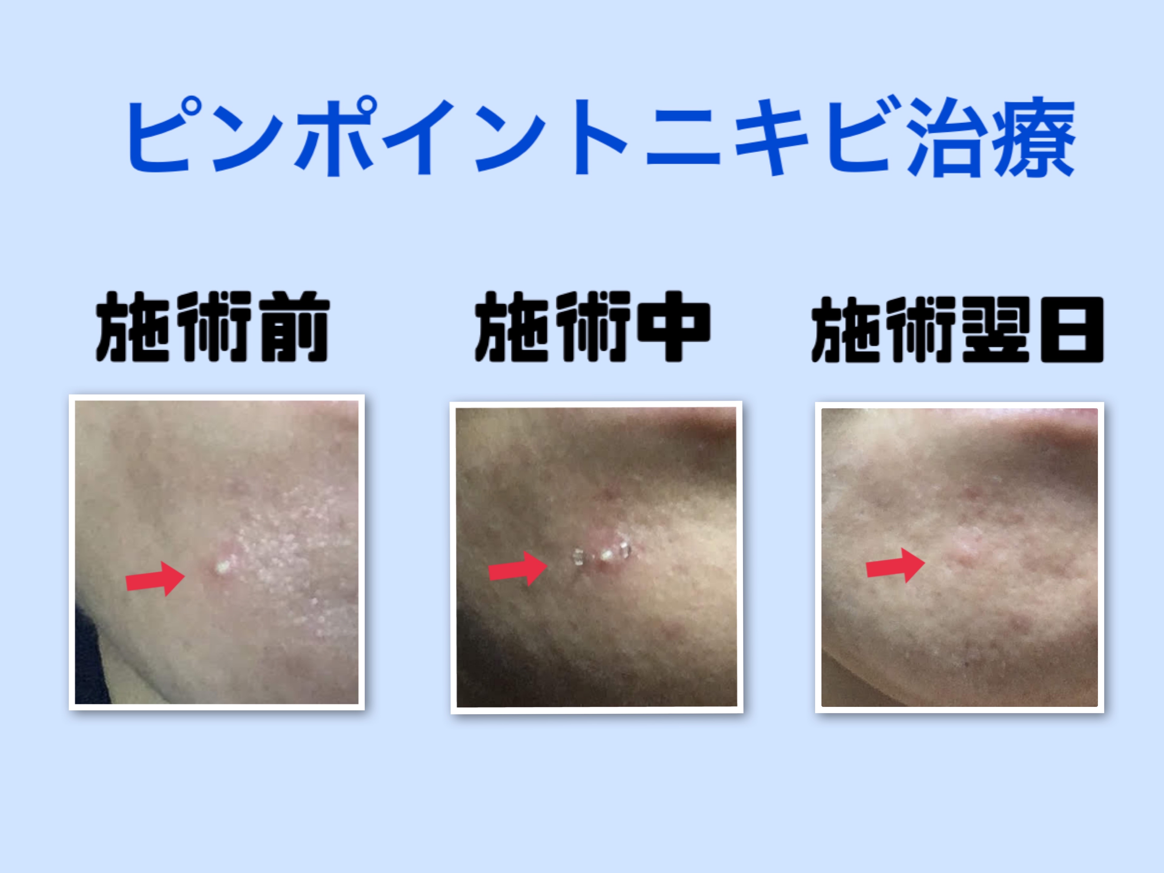 リラクゼーション鍼灸 HARIOKA 【オプション】ピンポイント皮内鍼のメニュー画像