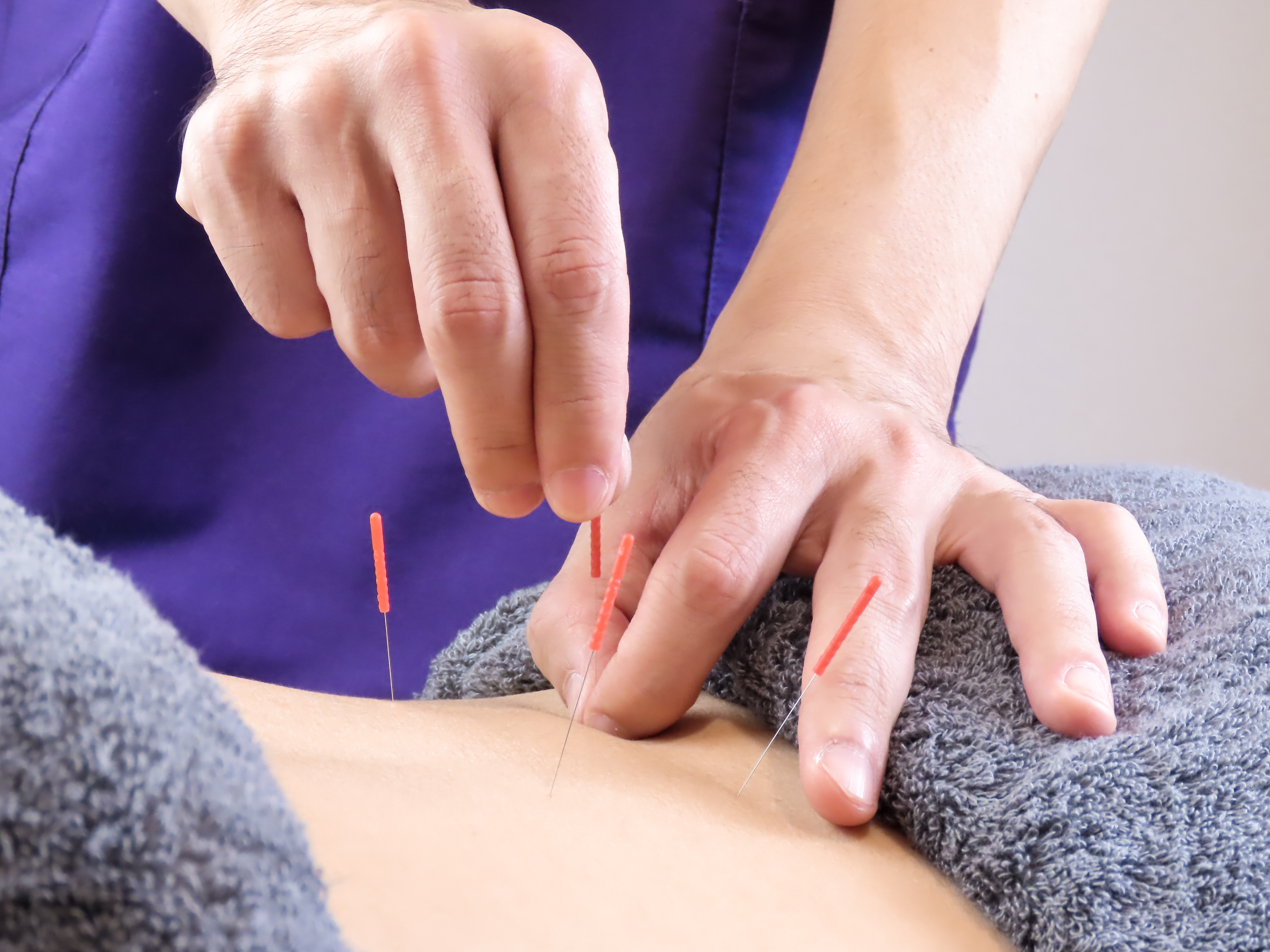 東武練馬鍼灸整体院shima 【初診】つらいぎっくり腰でお悩みの方　鍼灸のメニュー画像